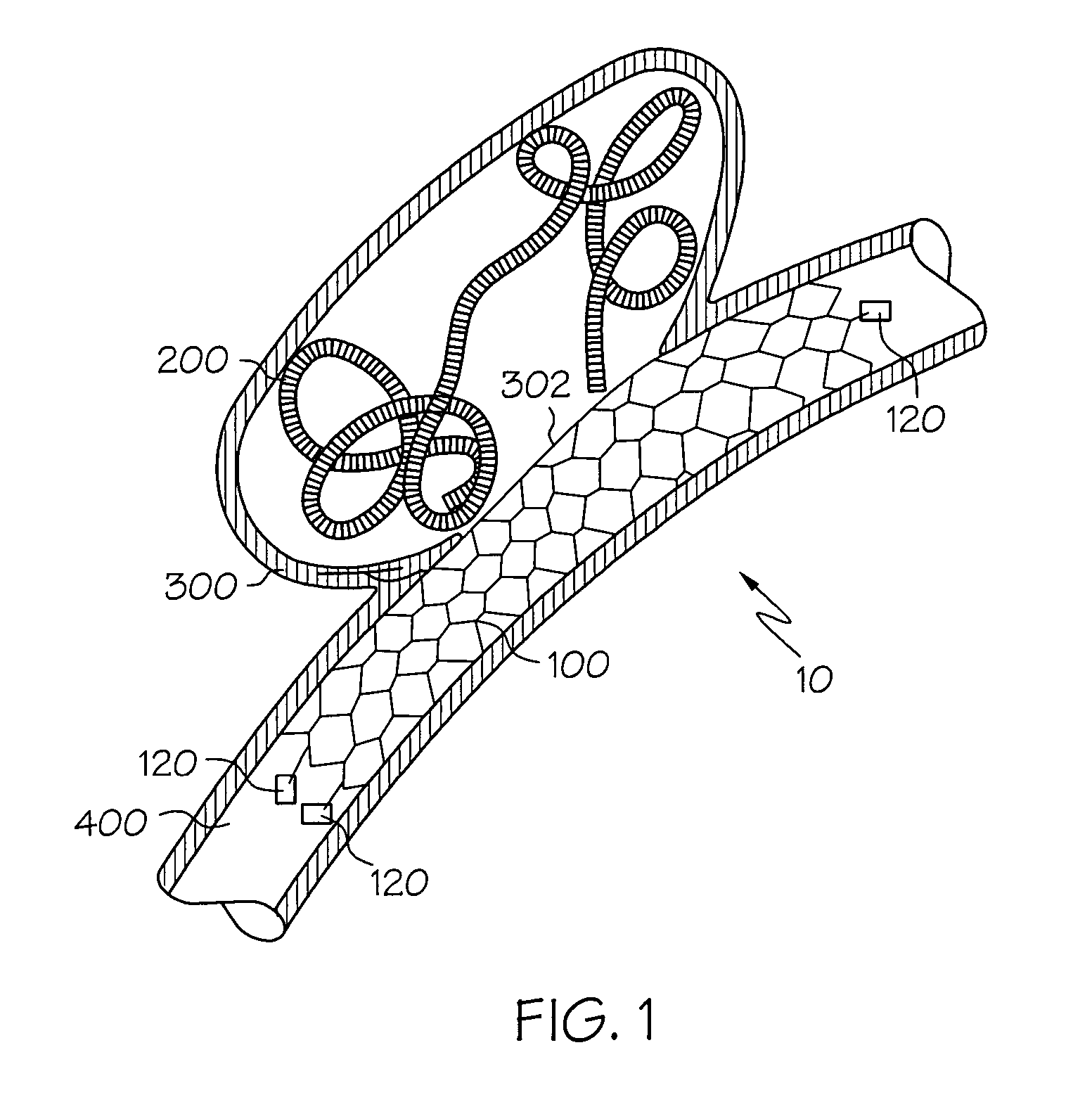 Sacrificial anode stent system