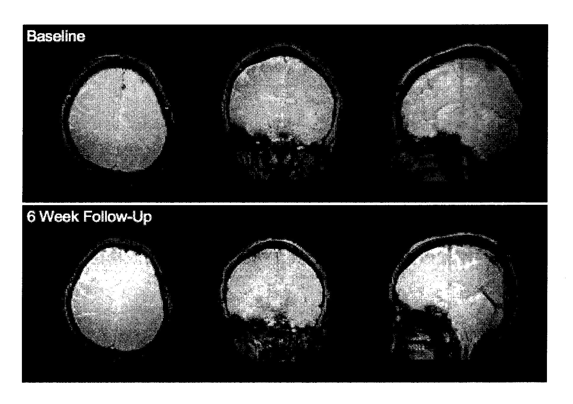 Methods for improving frontal brain bioenergetic metabolism