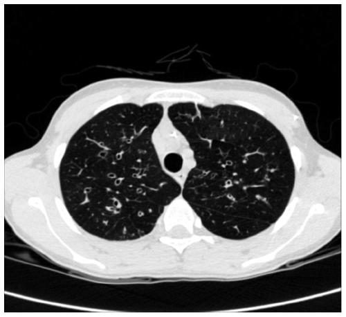 Enhanced CT image tracheal wall enhancement method, system, device and medium