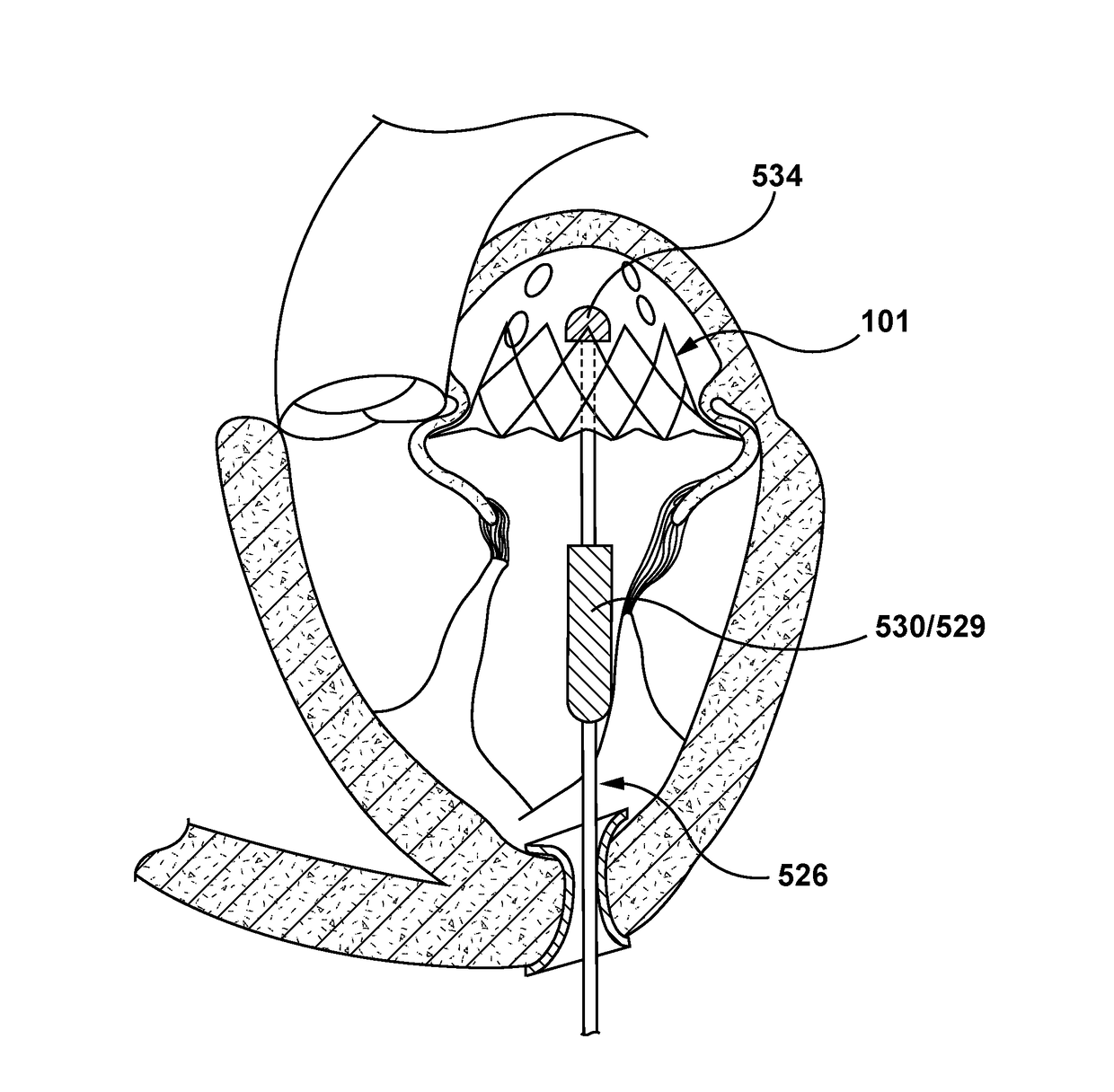 Valve delivery system having an integral displacement component for managing chordae tendineae in situ and methods of use thereof