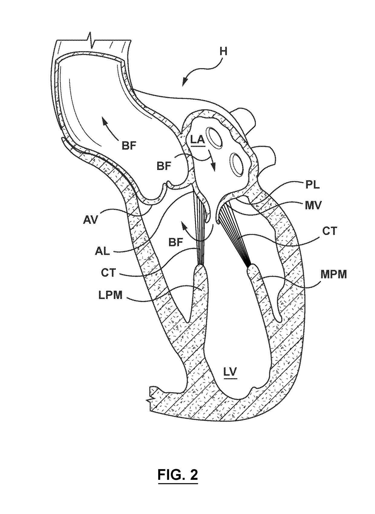 Valve delivery system having an integral displacement component for managing chordae tendineae in situ and methods of use thereof