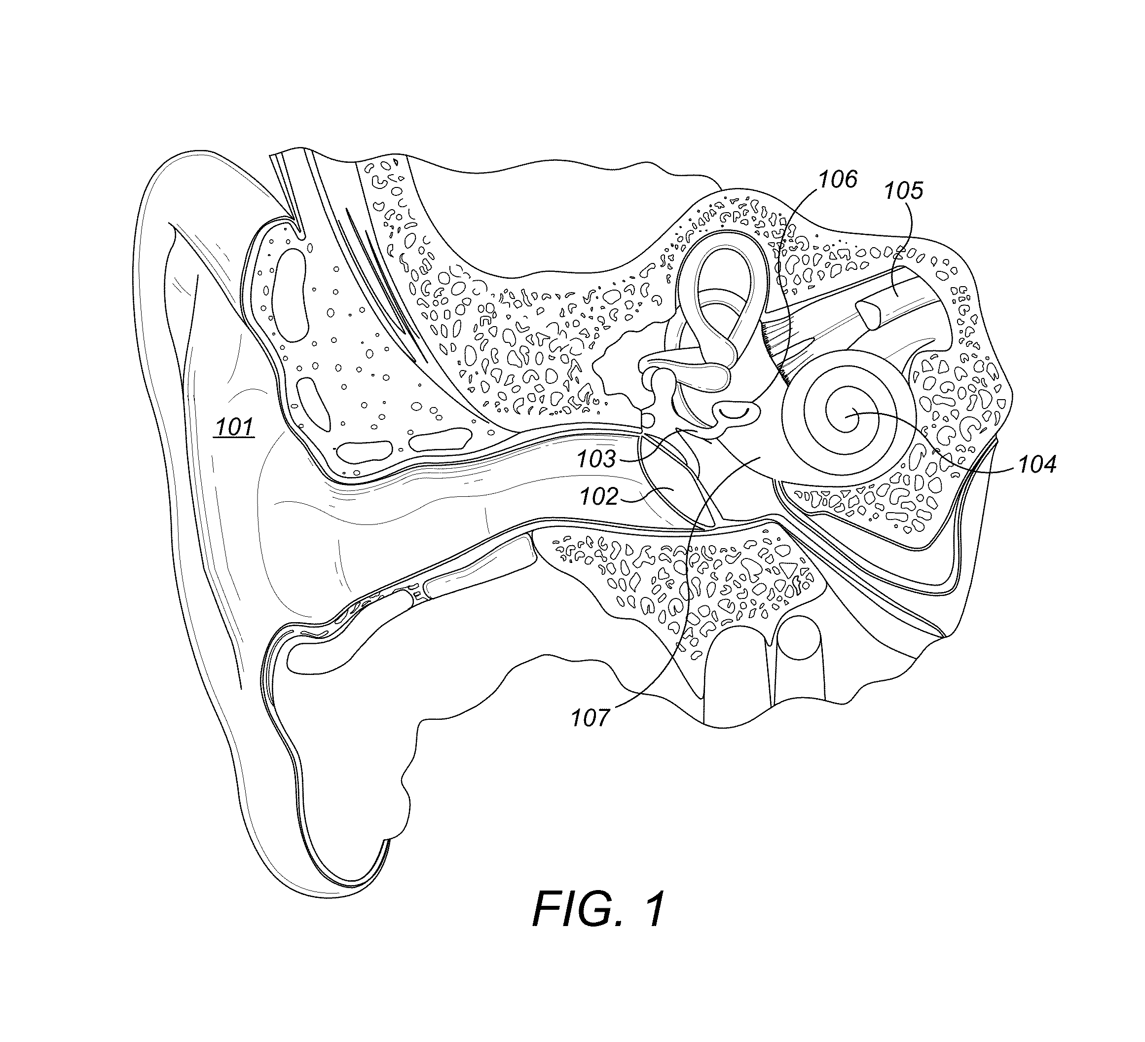 Magnet arrangement for bone conduction hearing implant