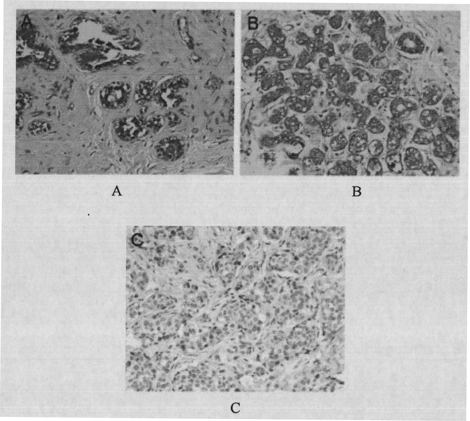 Humanized breast cancer antigen and antibody thereof