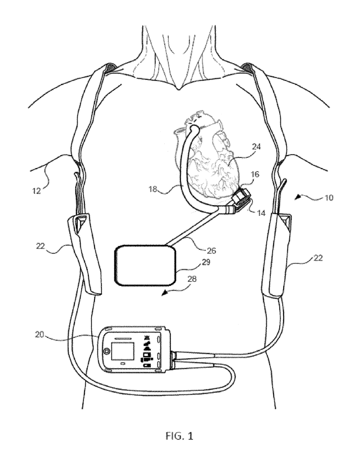 Mechanical Gauge for Estimating Inductance Changes in Resonant Power Transfer Systems With Flexible Coils for Use With Implanted Medical Devices