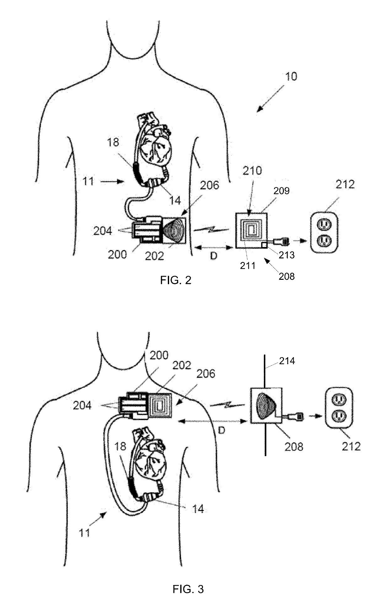 Mechanical Gauge for Estimating Inductance Changes in Resonant Power Transfer Systems With Flexible Coils for Use With Implanted Medical Devices