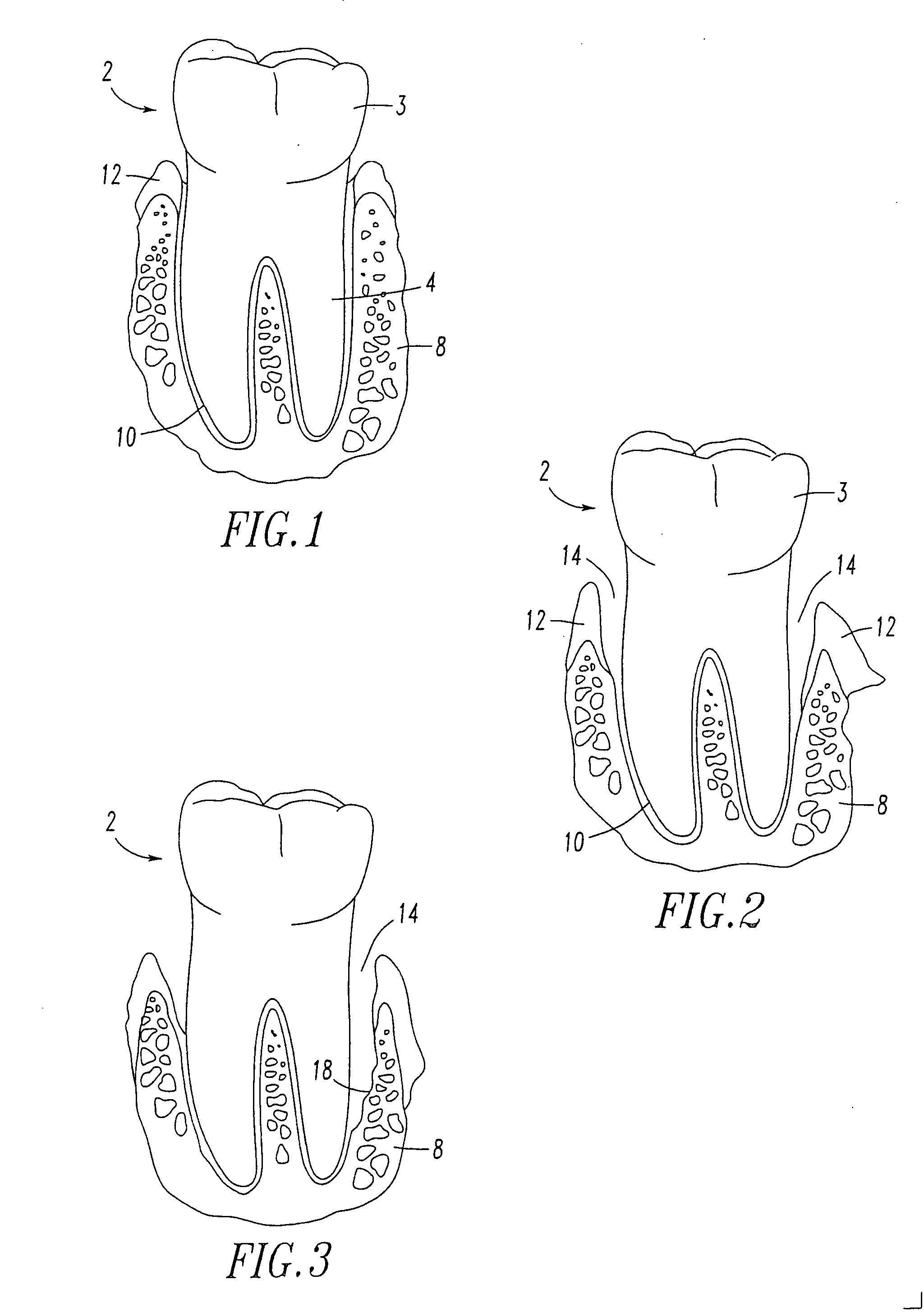 Periodontal regeneration composition and method of using same