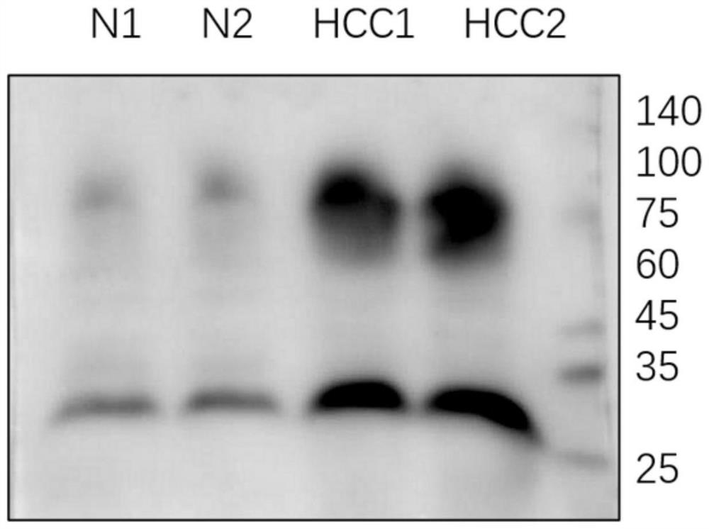 A liver cancer biomarker and kit for detecting liver cancer