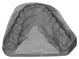 Method for acquisition of complete dentition model by computer rectification combination by sectionally taking model