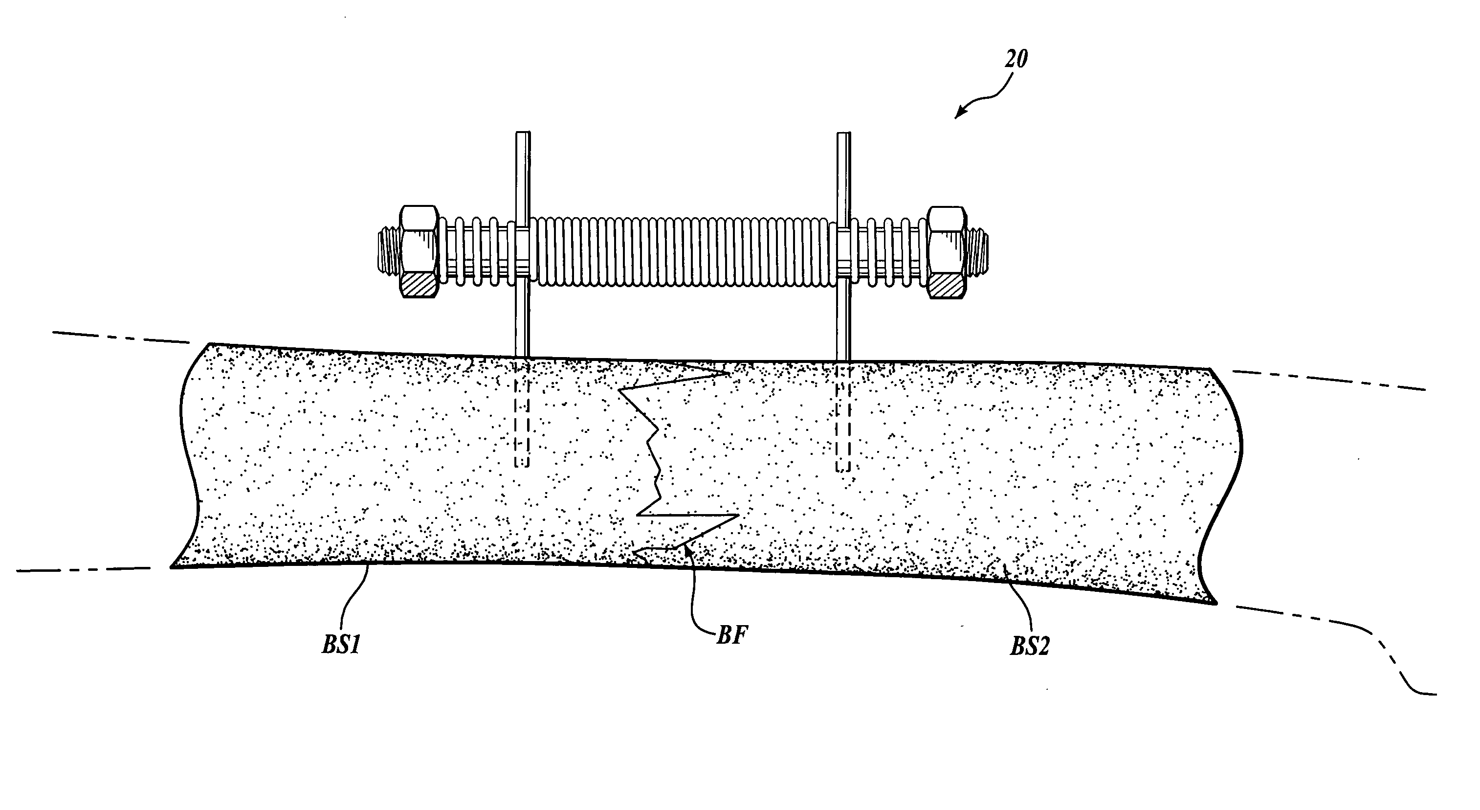 Device and method for fixing bone segments