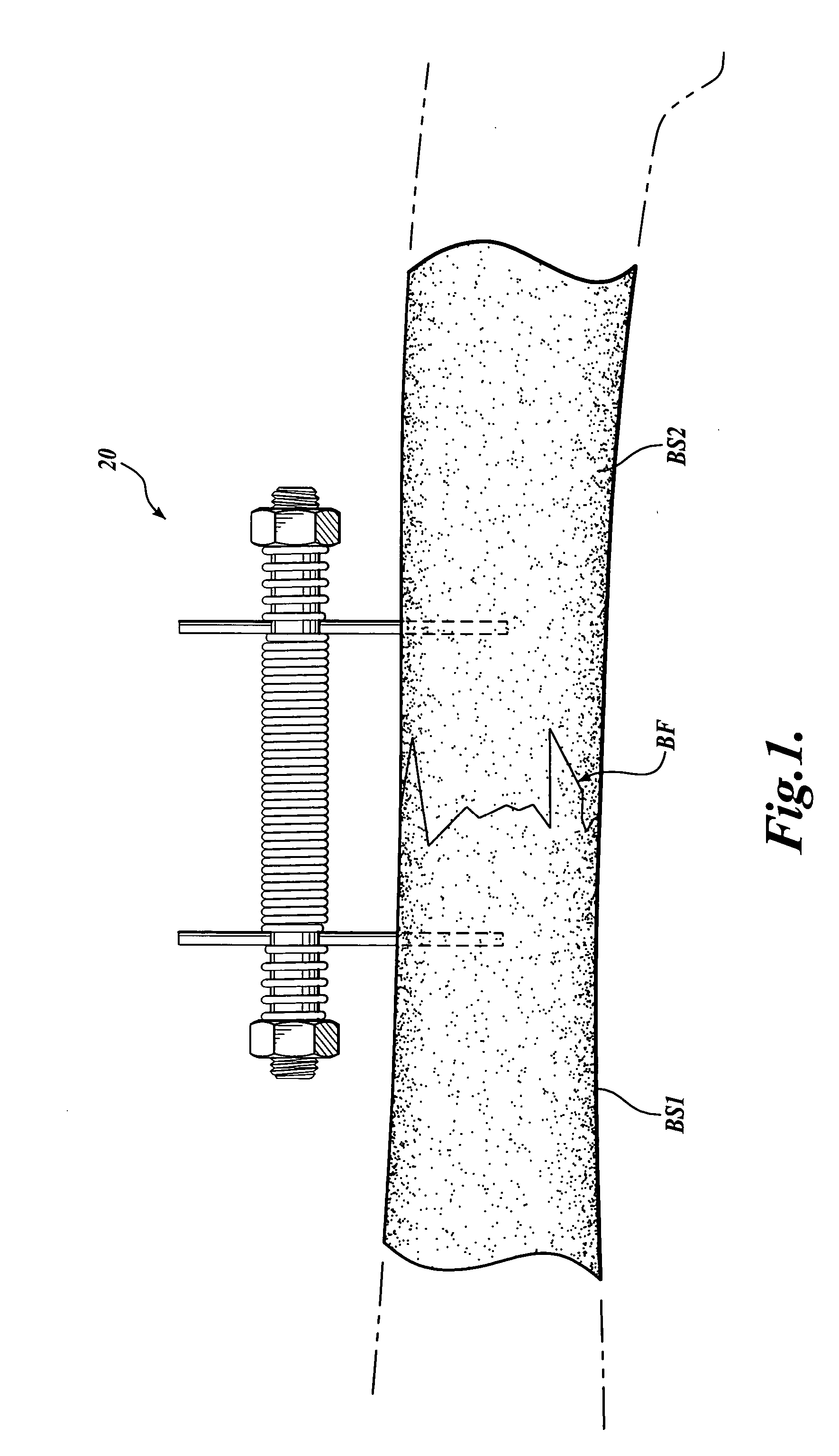 Device and method for fixing bone segments