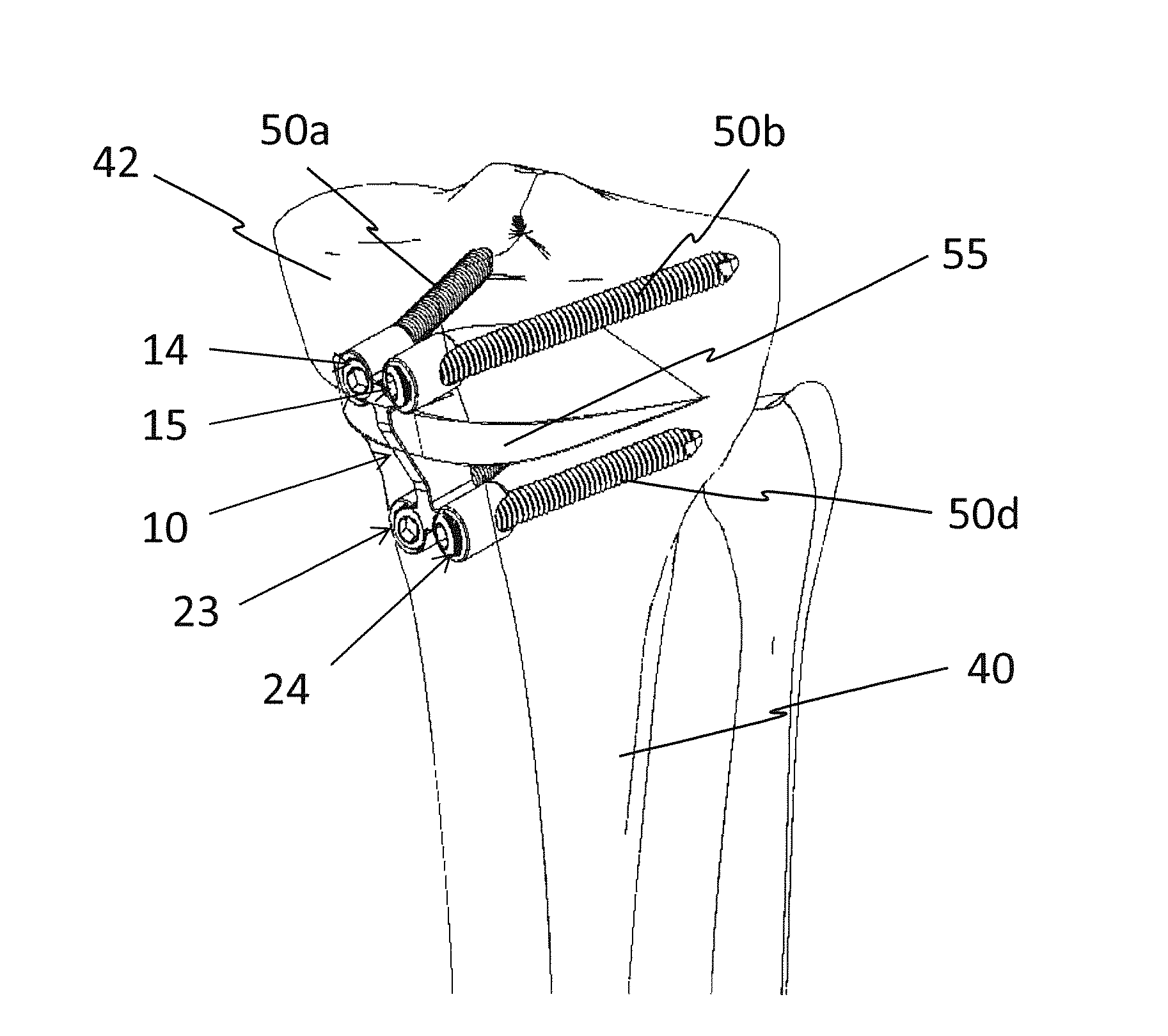 Osteotomy implant