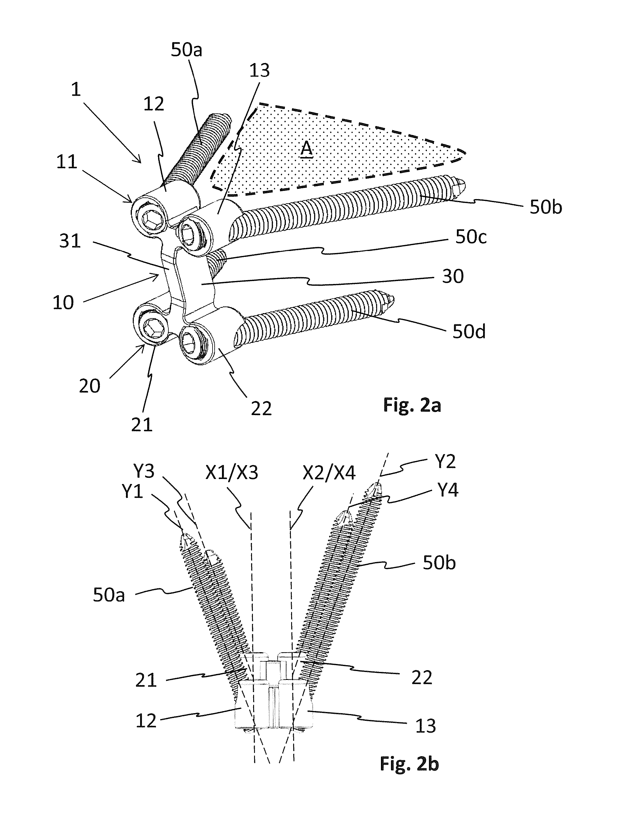 Osteotomy implant