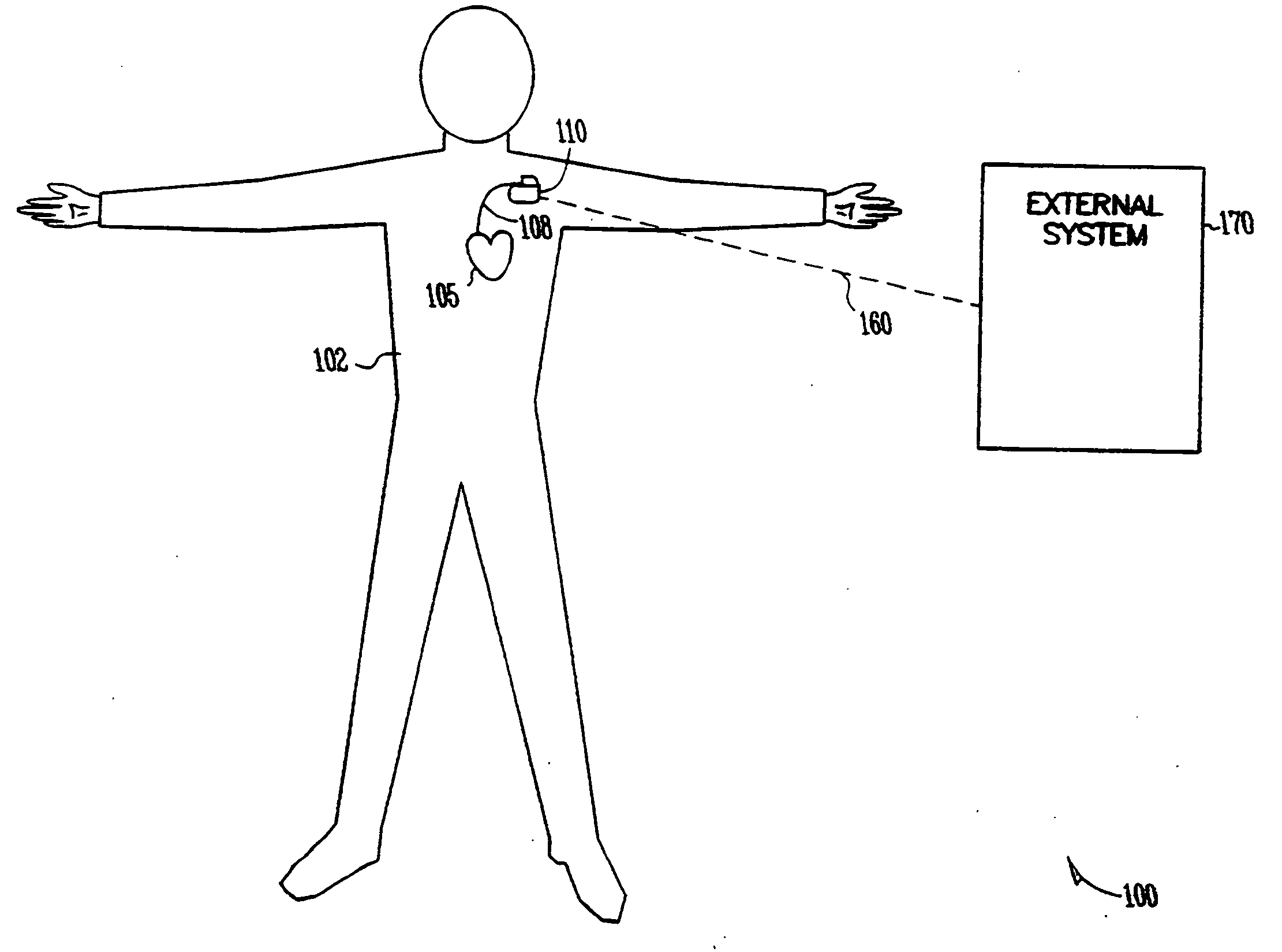 Method for correction of posture dependence on heart sounds