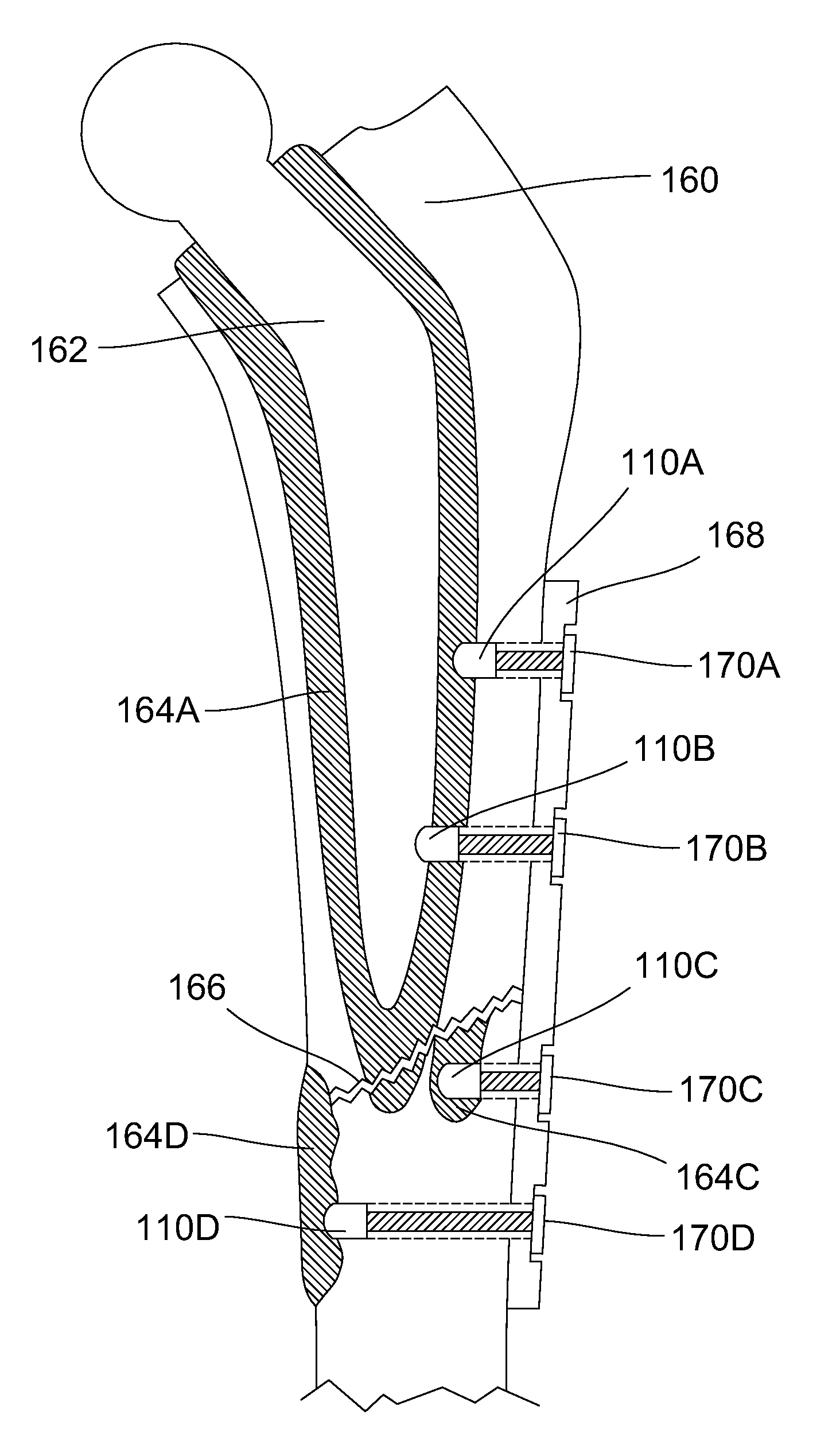 Methods and devices for utilizing bondable materials