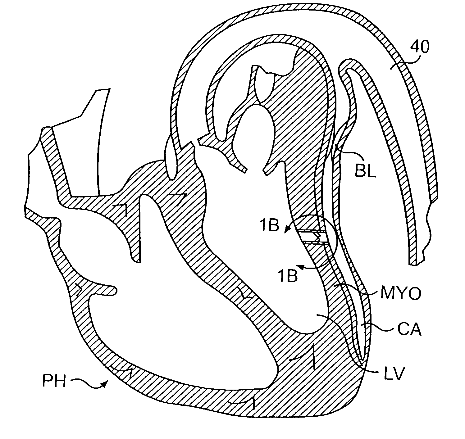 Valve designs for left ventricular conduits