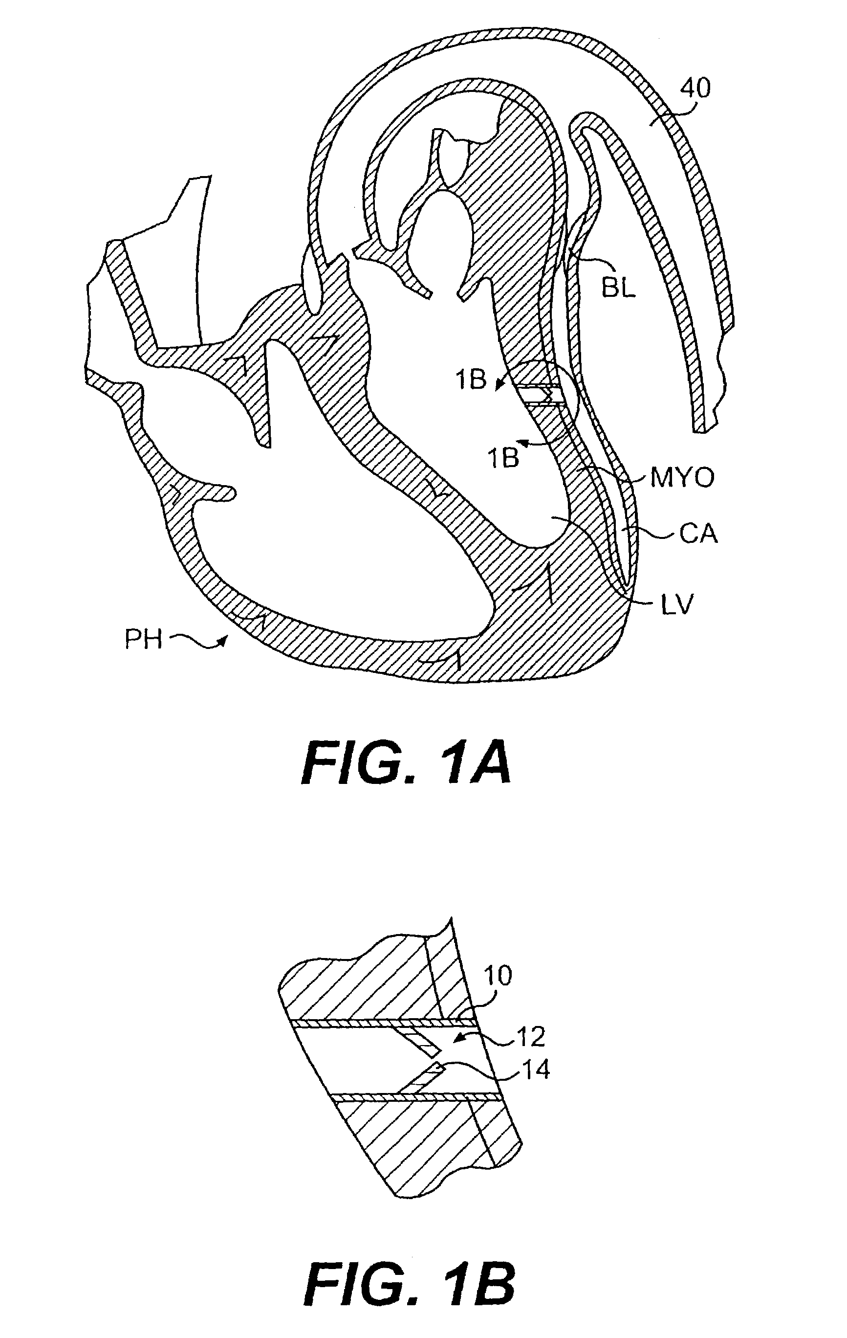 Valve designs for left ventricular conduits