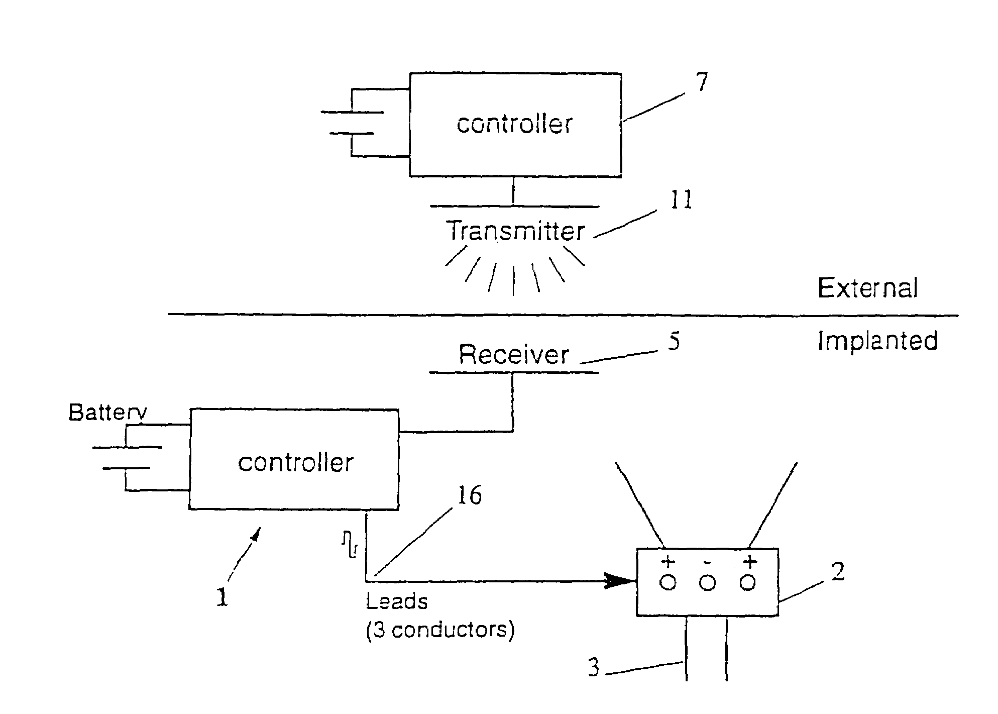 Method and apparatus for treating incontinence