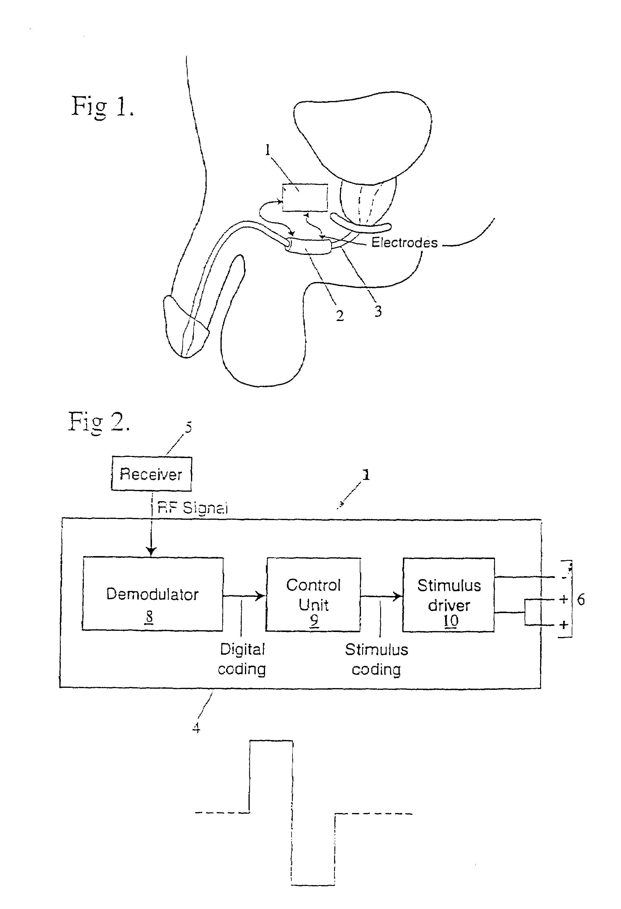 Method and apparatus for treating incontinence