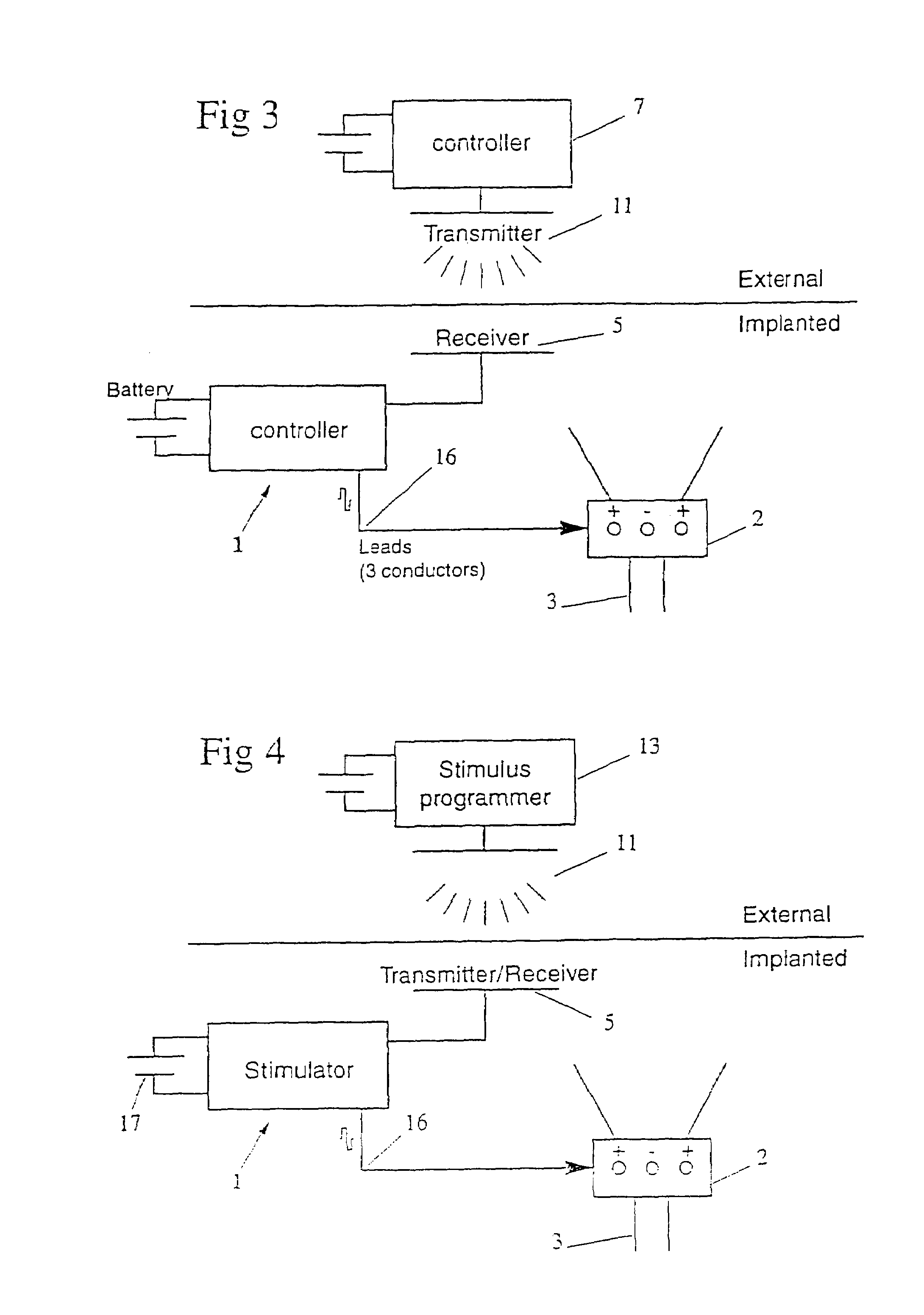 Method and apparatus for treating incontinence