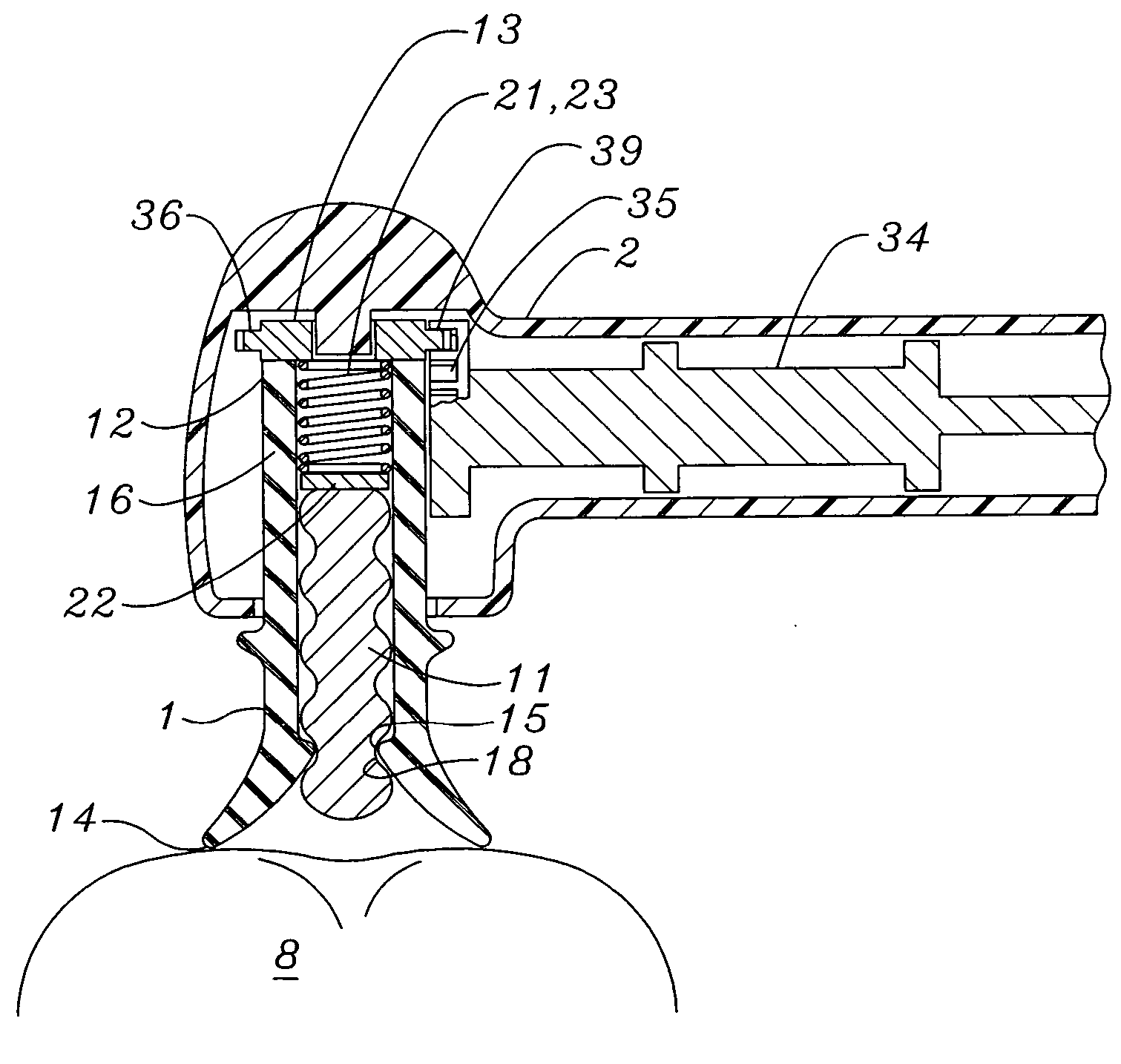 All-in-one prophy angle