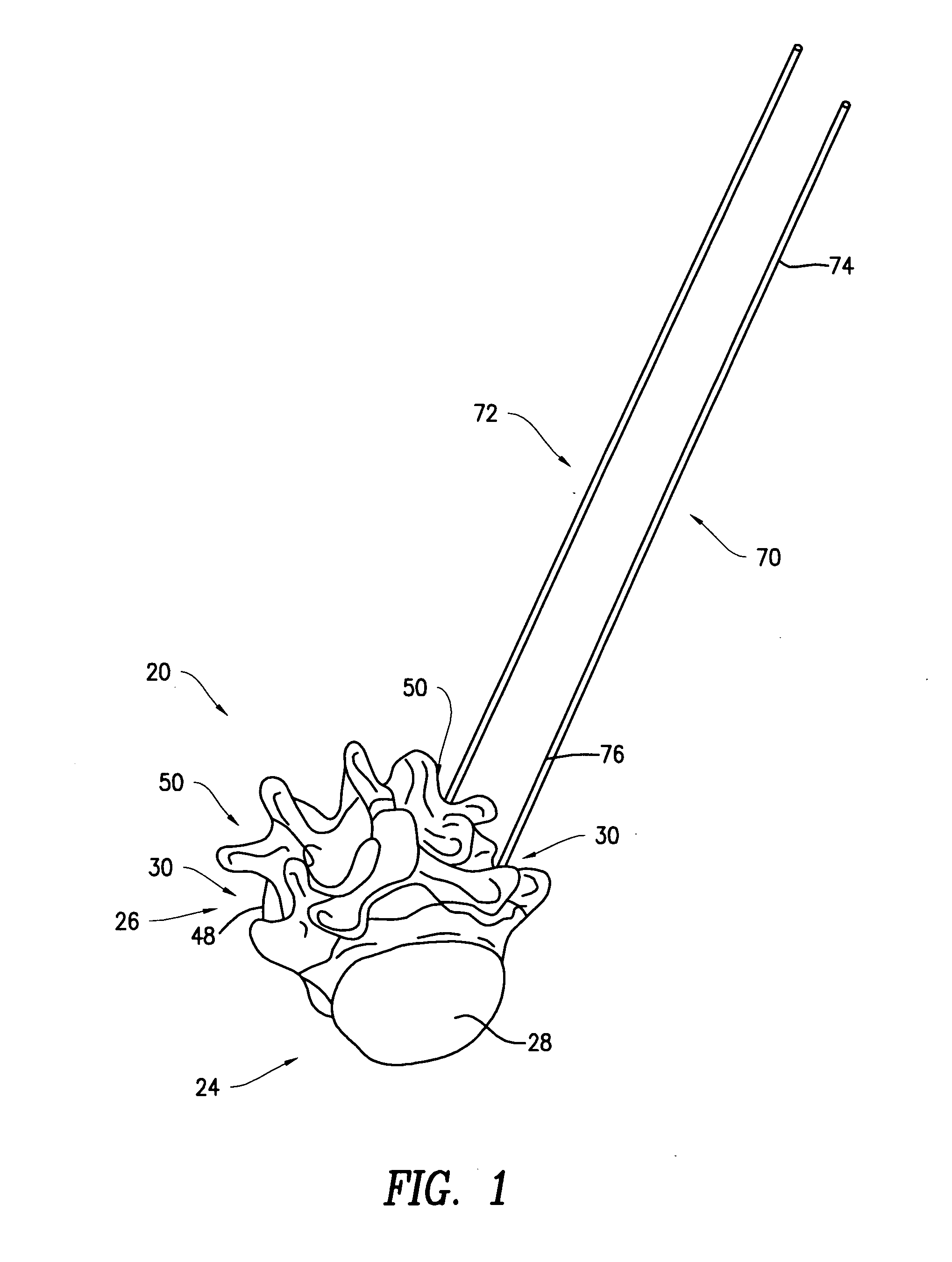 Rod contouring alignment linkage