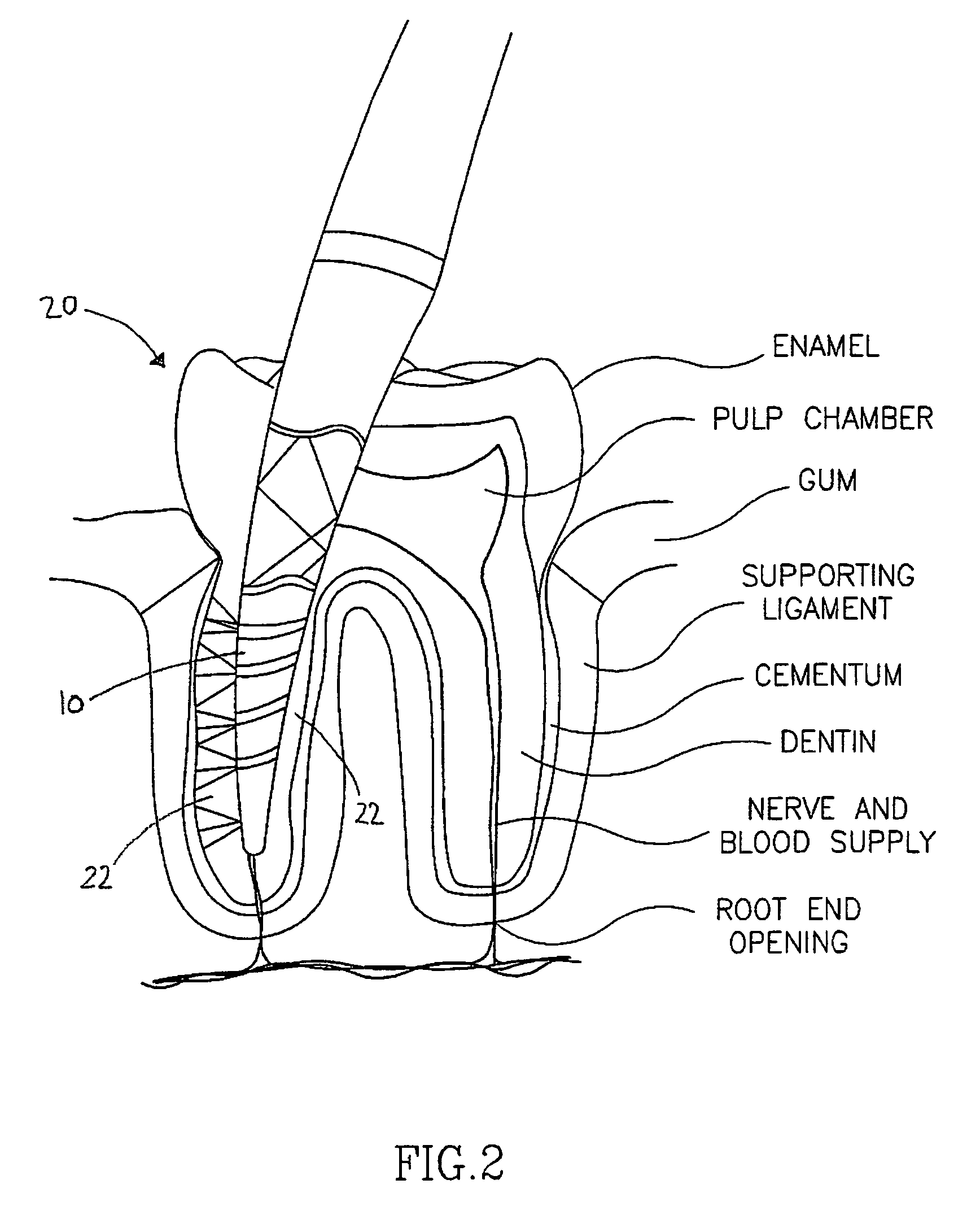 Laser instrument for endodontic treatment