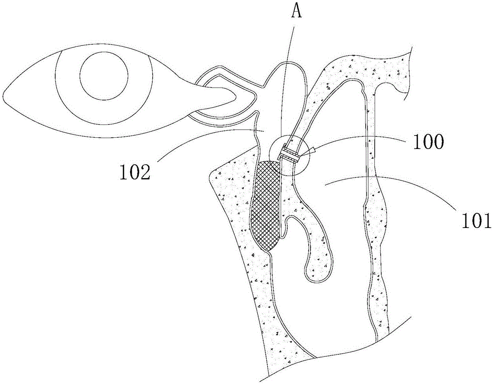 Auxiliary lacrimal duct