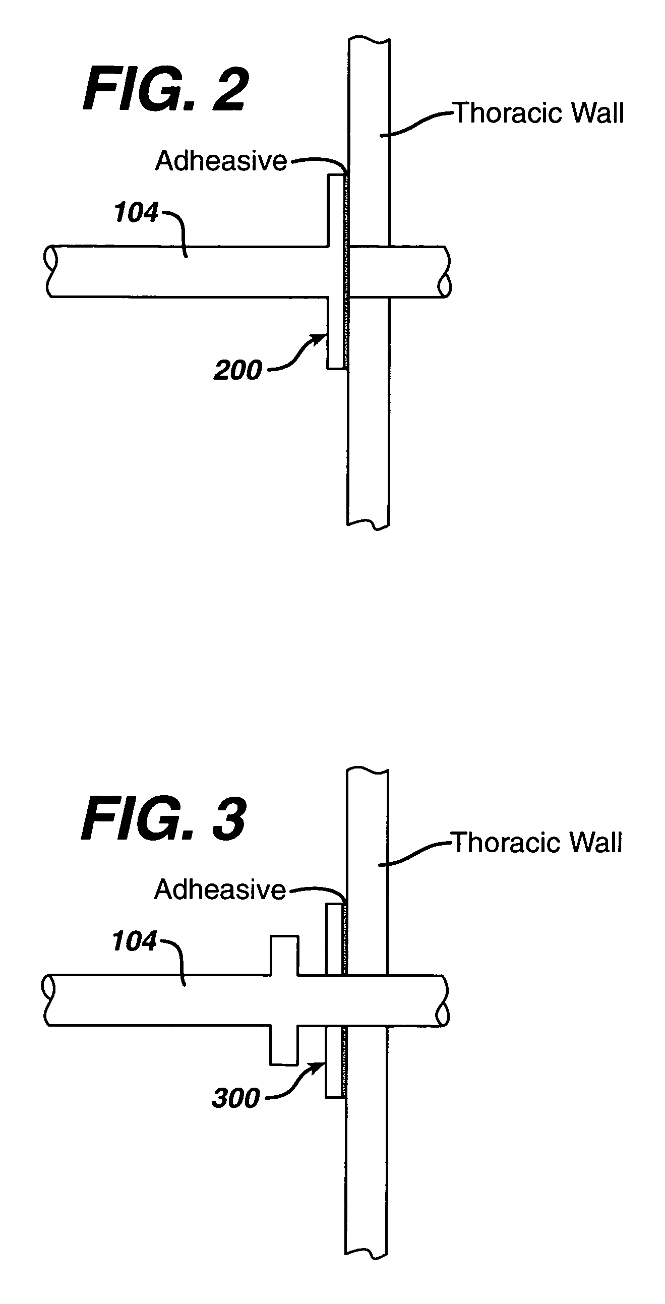 Collateral ventilation device with chest tube/evacuation features