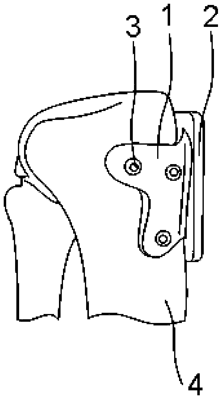 Osteotomy guide plate in operation of precisely treating tibial tuberosity introversion and application of osteotomy guide plate