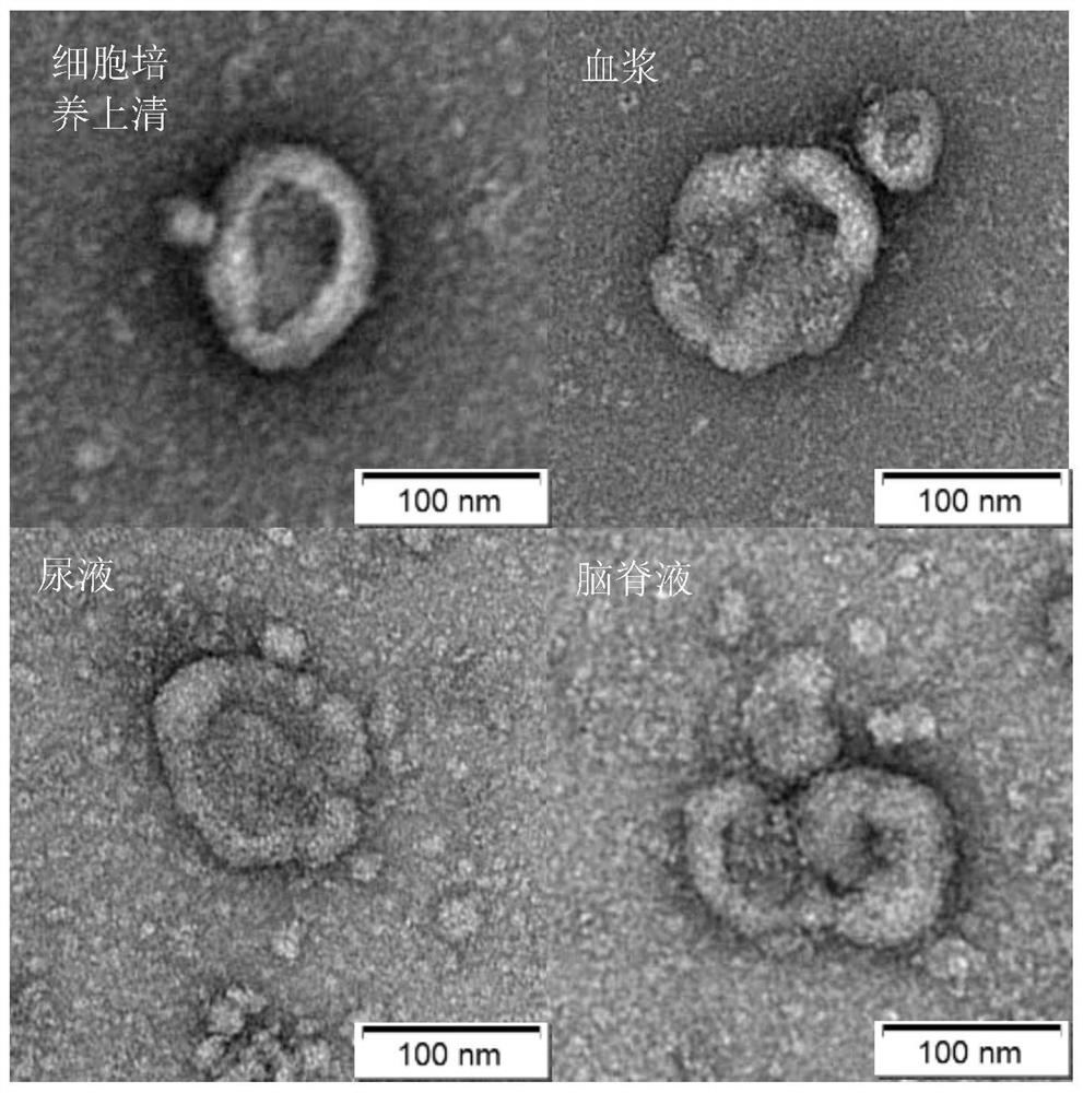 A Lectin-Magnetic Carrier Conjugated Complex for the Isolation of Glycosylated Exosomes from Clinical Samples