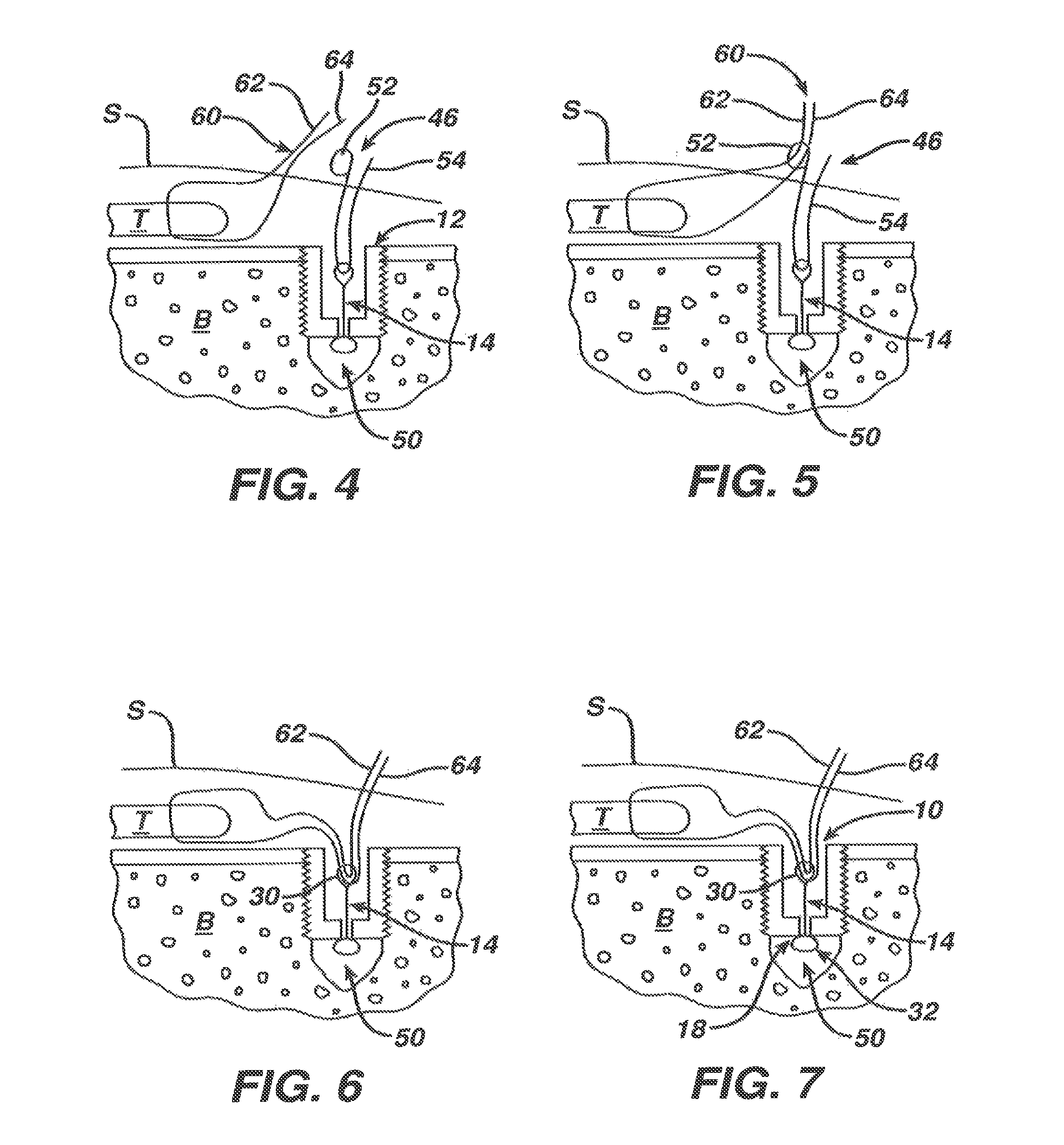 Surgical filament snare assemblies