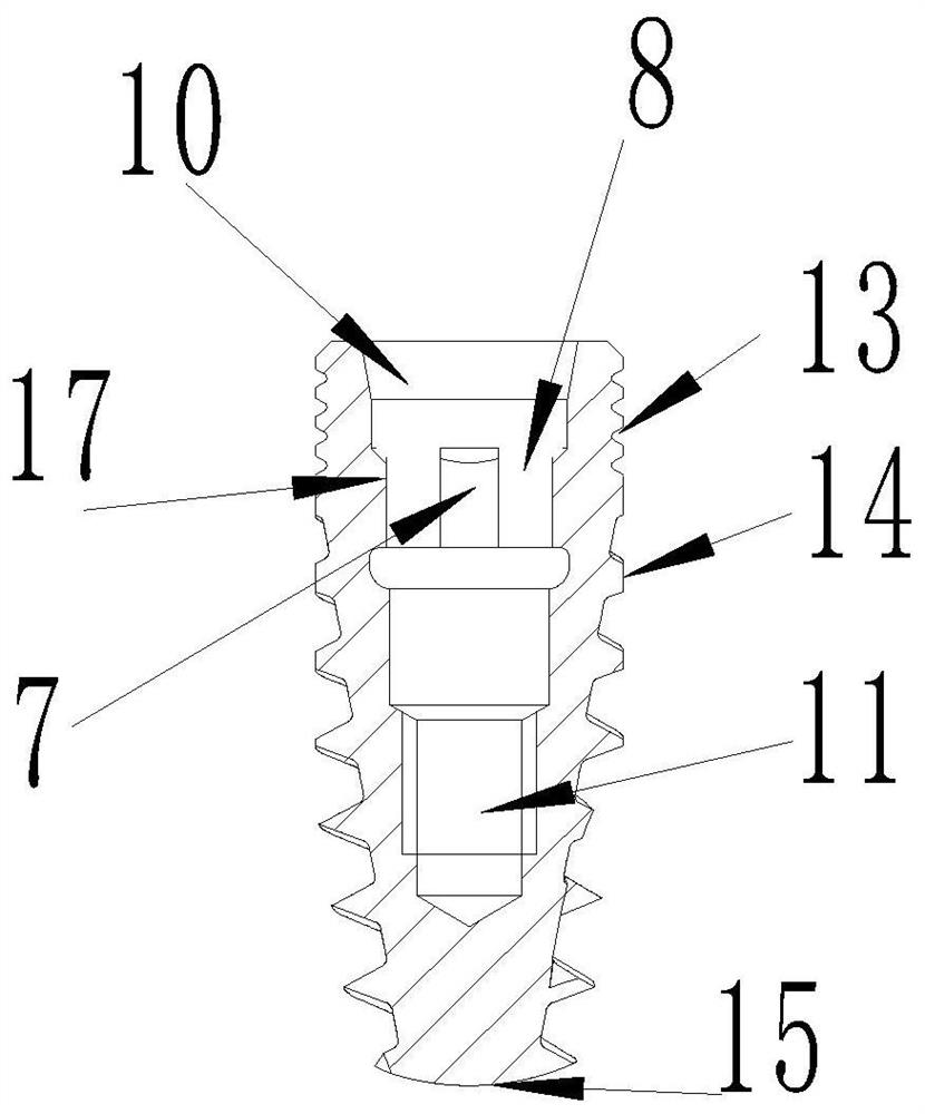 An anti-resorptive implant