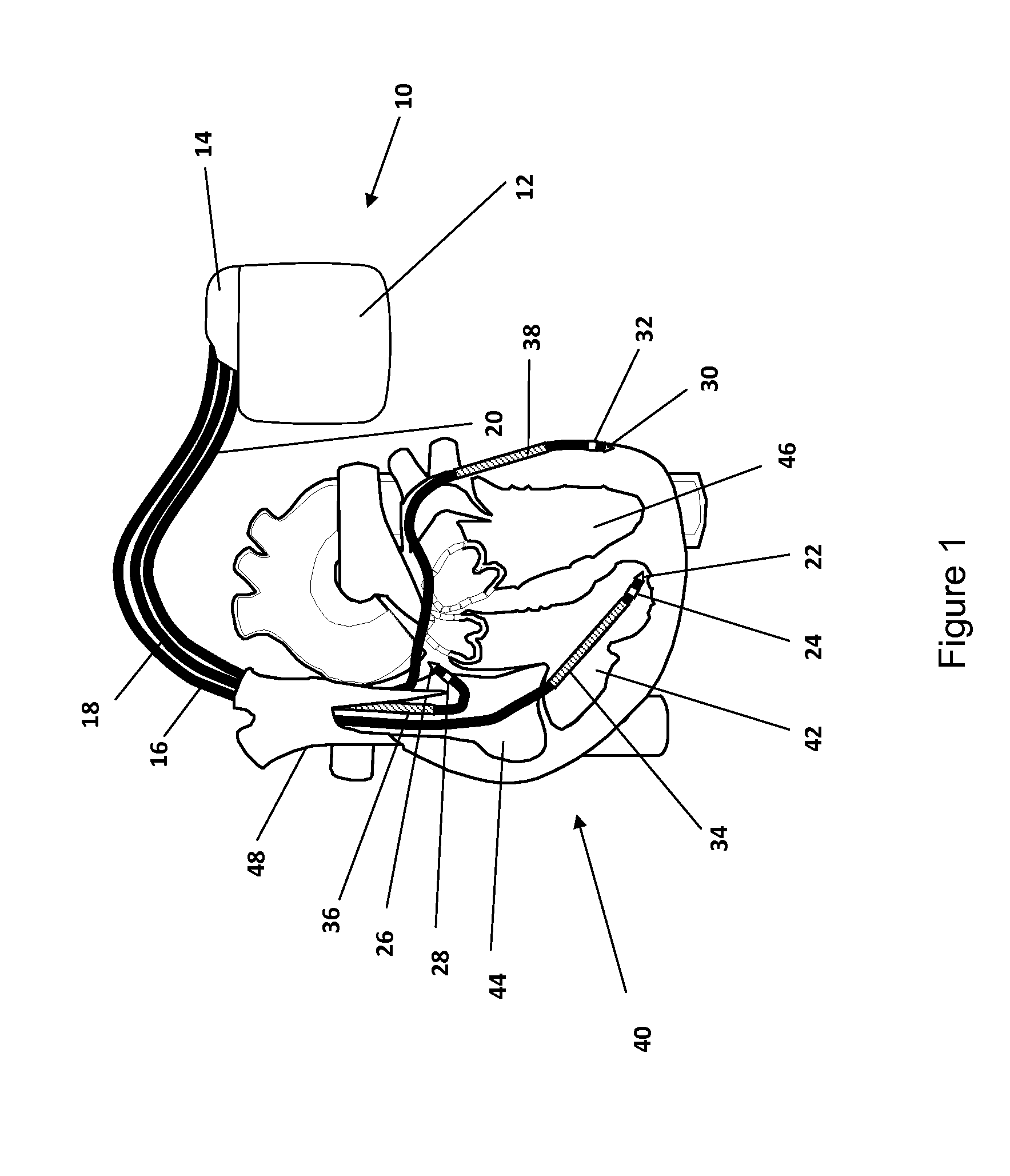 Device and method for fusion beat detection