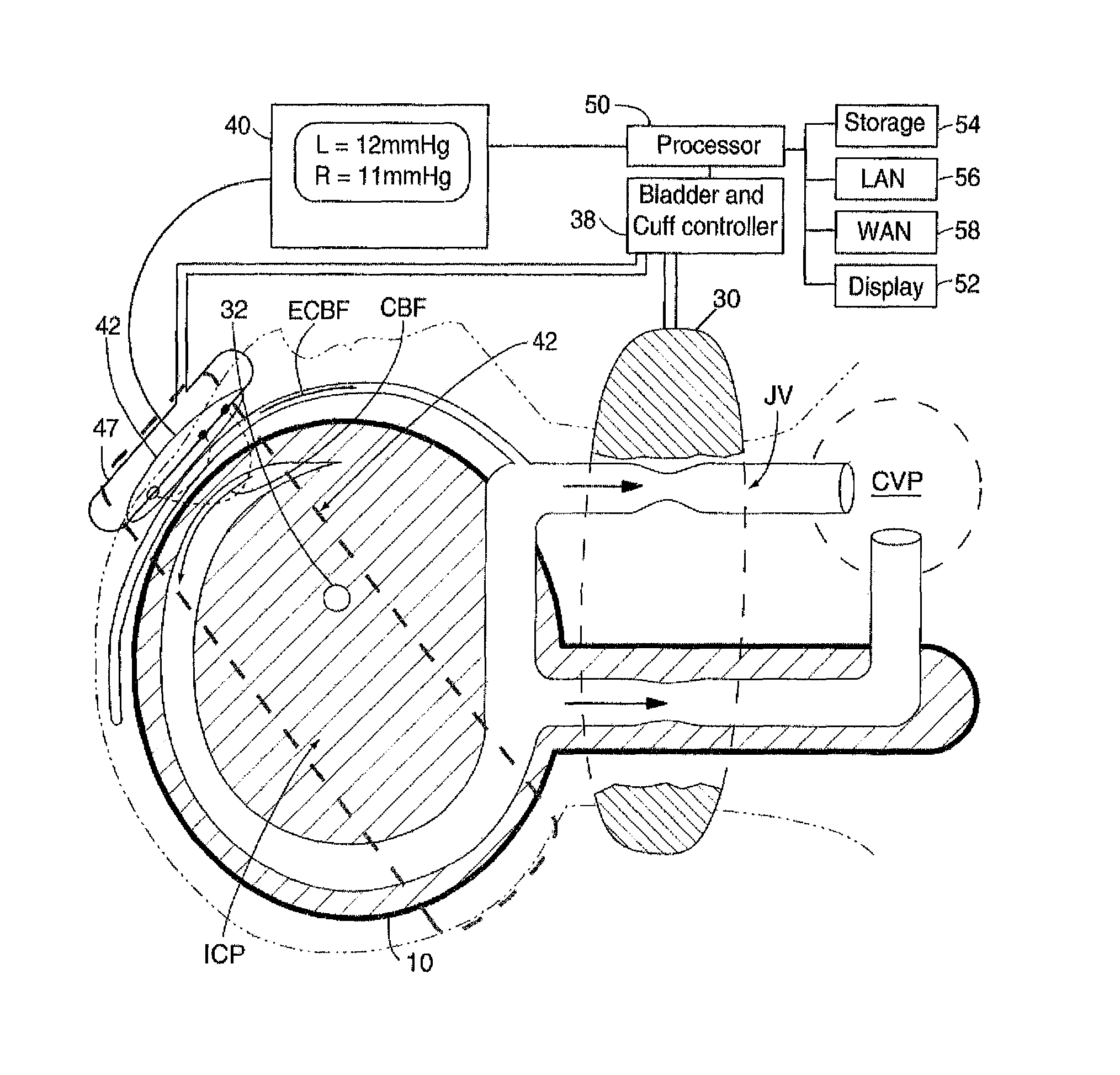 Noninvasive method to measure intracranial and effective cerebral outflow pressure