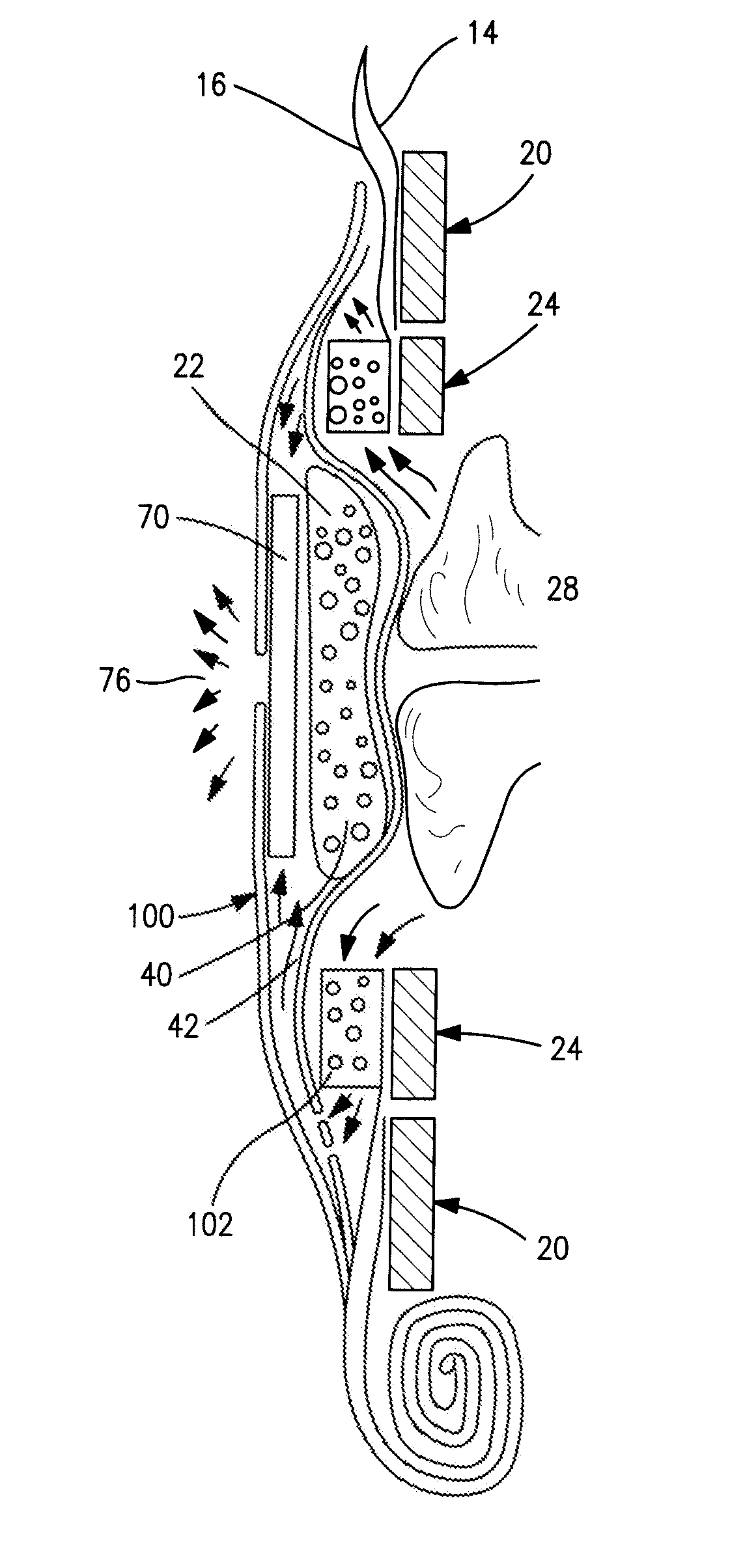 Controlled evacuation ostomy appliance