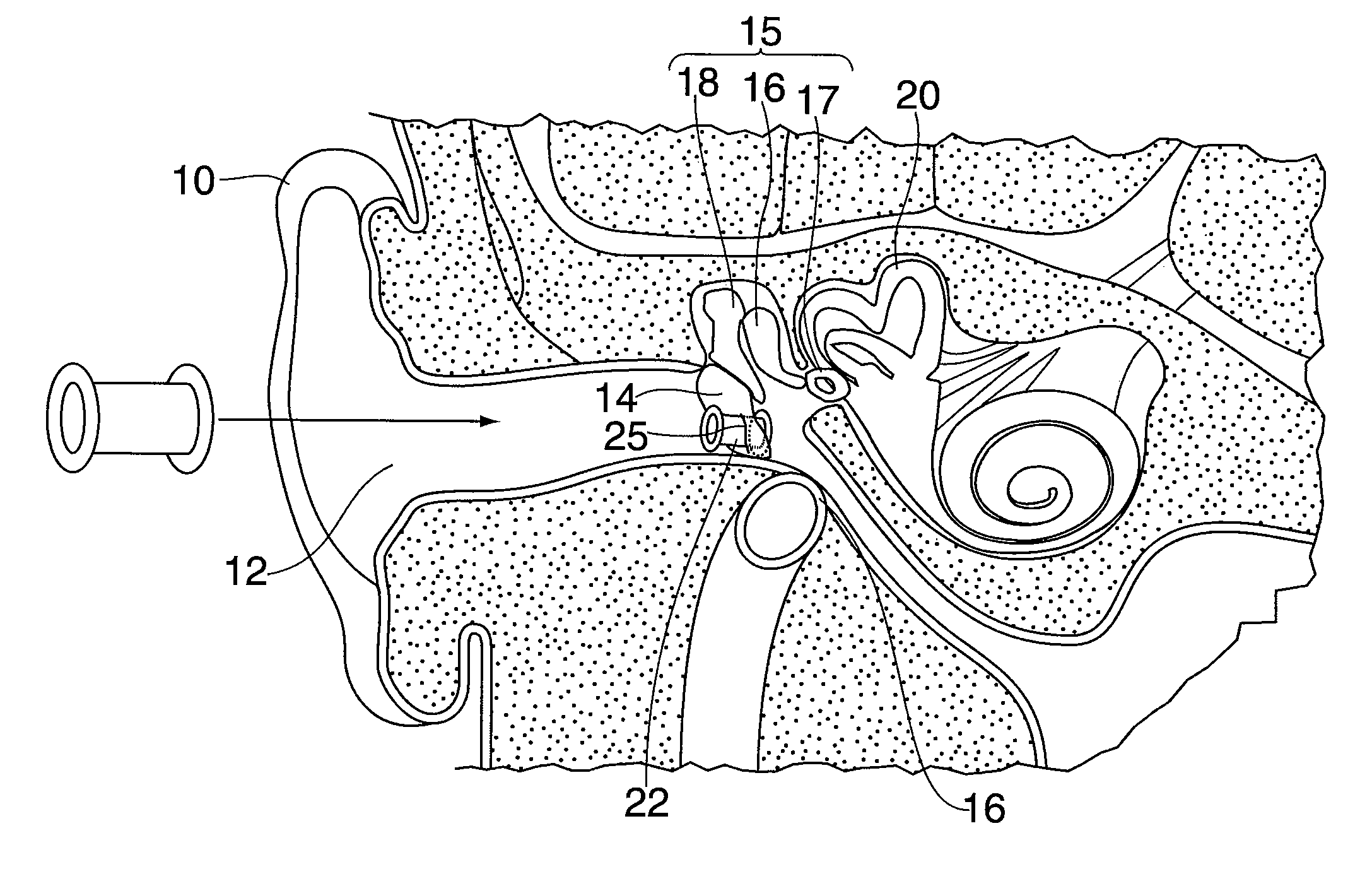 Implantable hearing aid