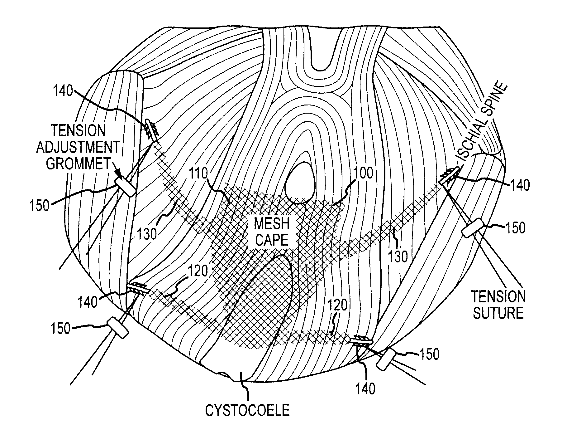 Systems and methods for treating anterior pelvic organ prolapse