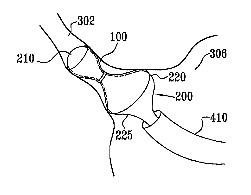 Varying diameter vascular implant and balloon