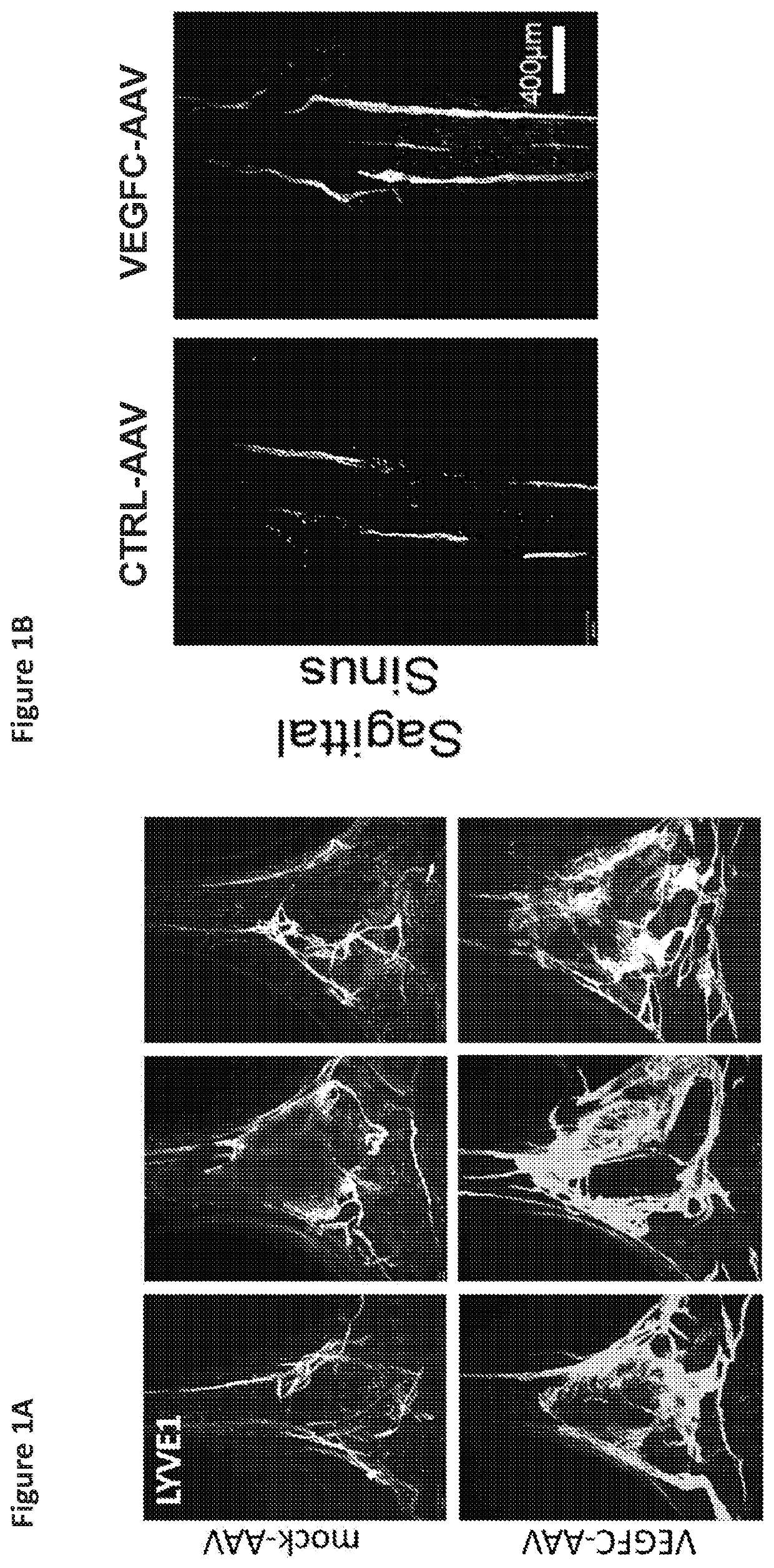 Manipulation of meningeal lymphatic vasculature for brain and CNS tumor therapy