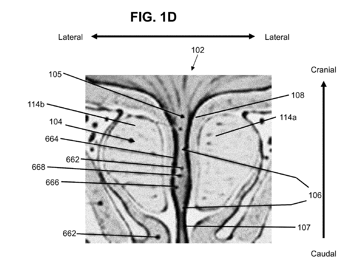 Dilating device and method for prostatic urethra