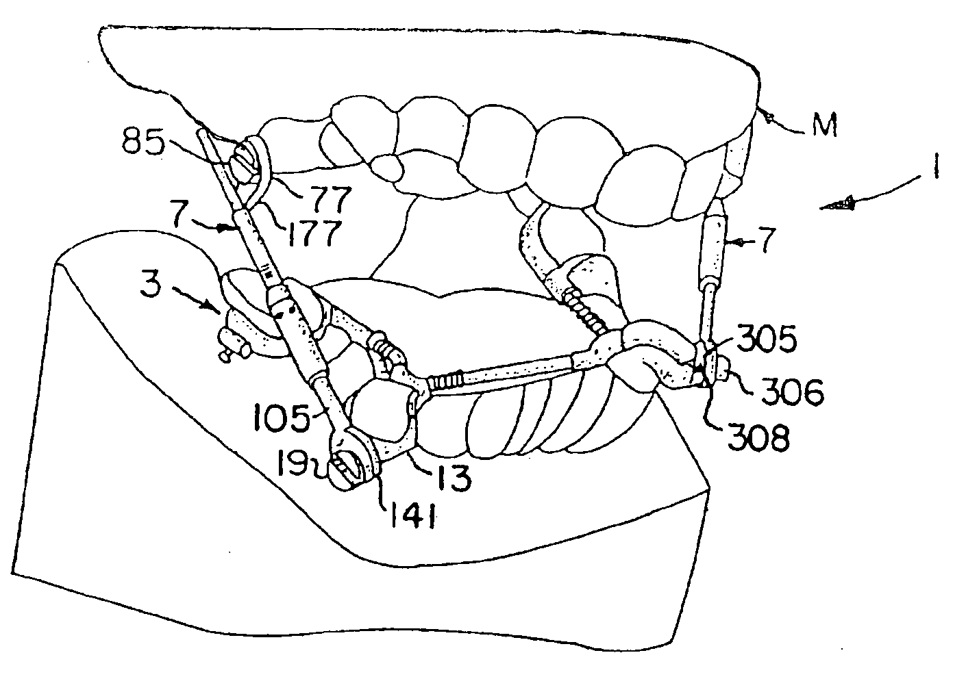 Slide on connector for arch wire