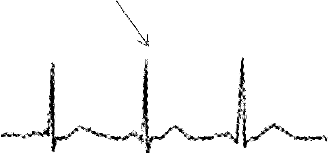 Myocardial excitation contraction coupling time diagnostic apparatus and application thereof