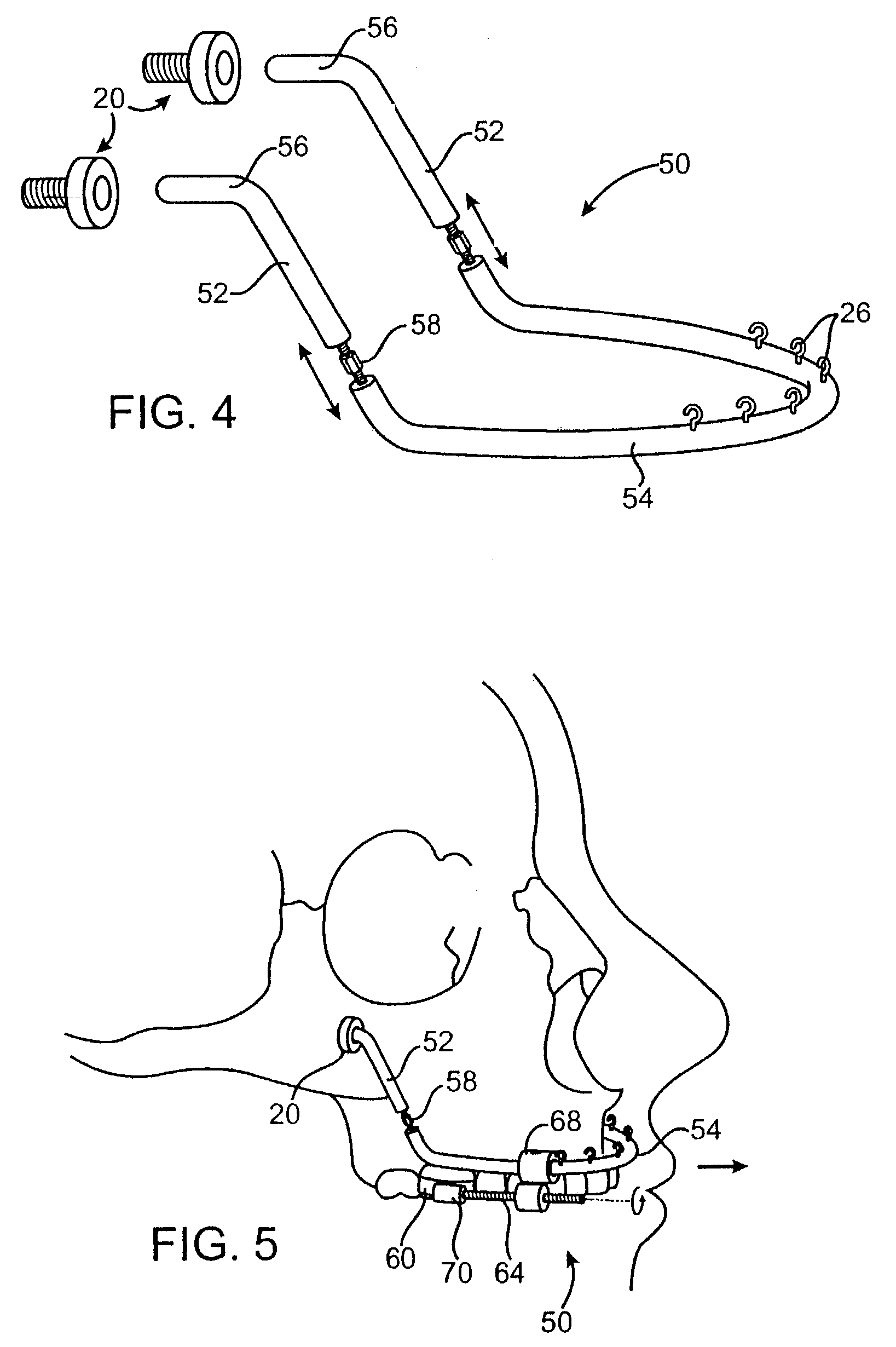 Maxillary distraction device