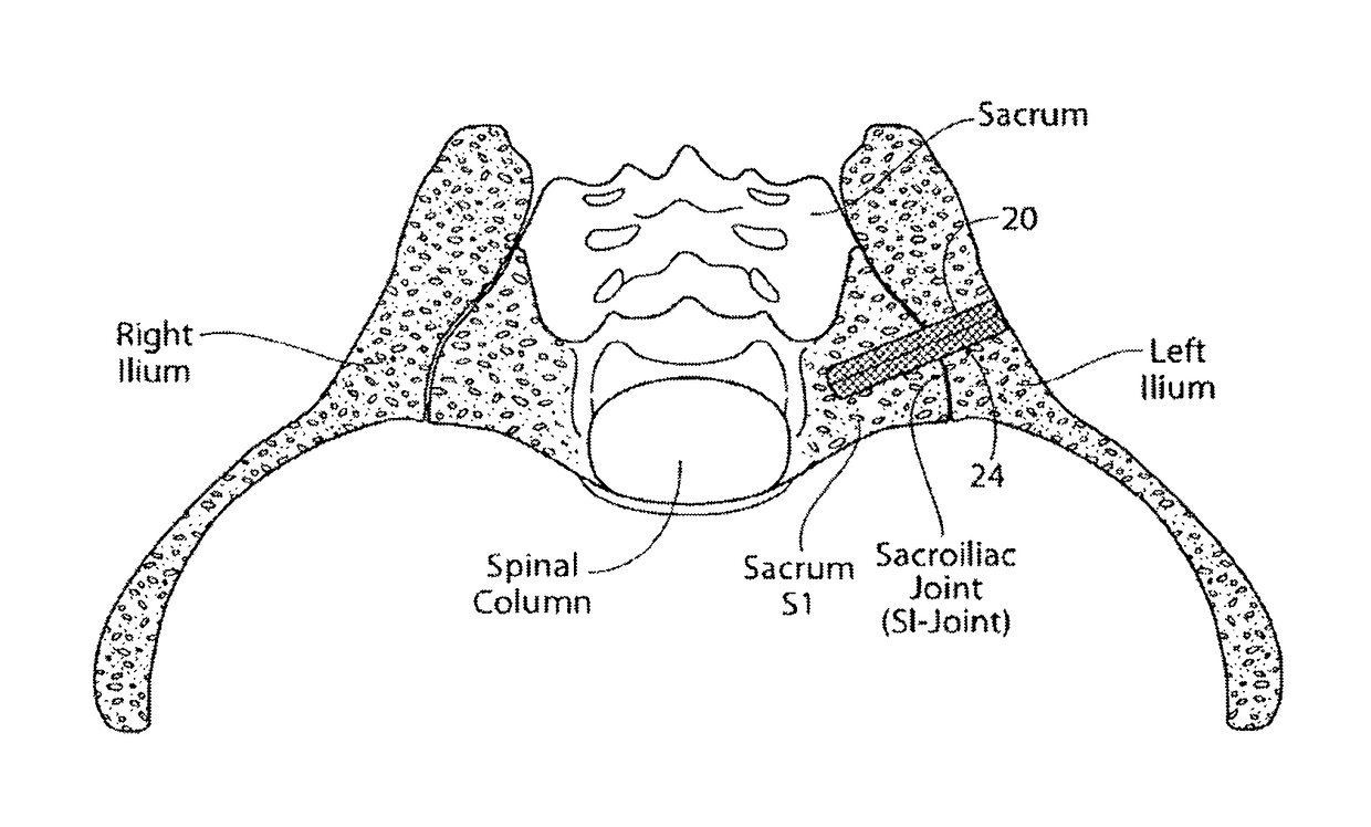 Apparatus, systems, and methods for the fixation or fusion of bone