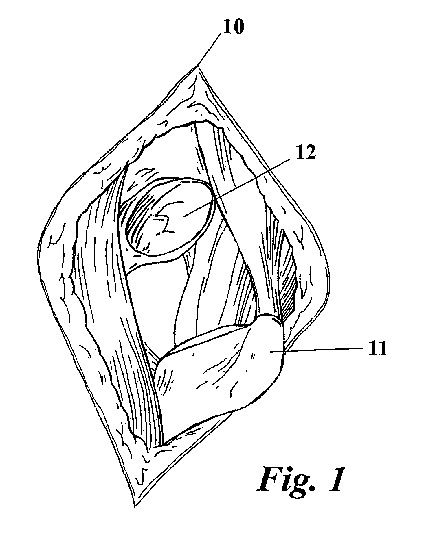 Apparatus and method for minimally invasive total joint replacement