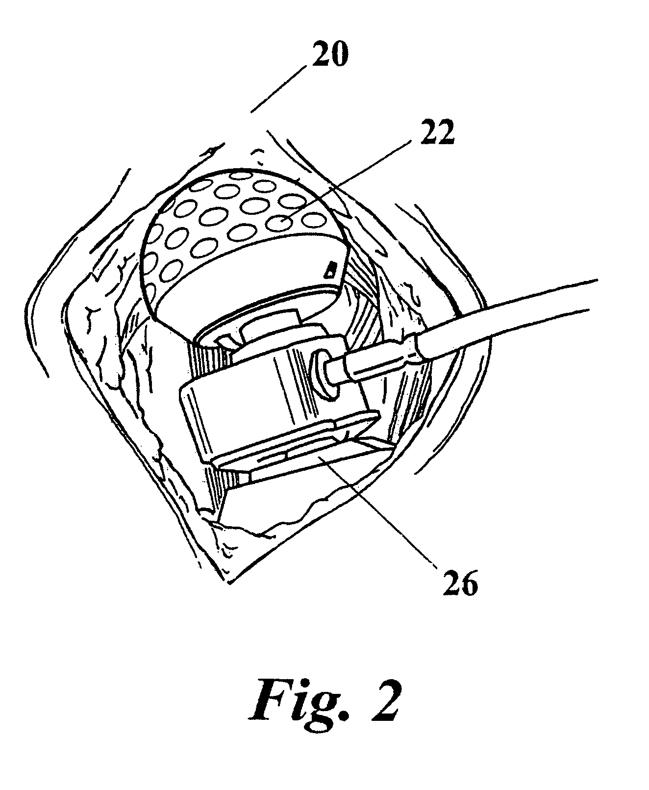 Apparatus and method for minimally invasive total joint replacement