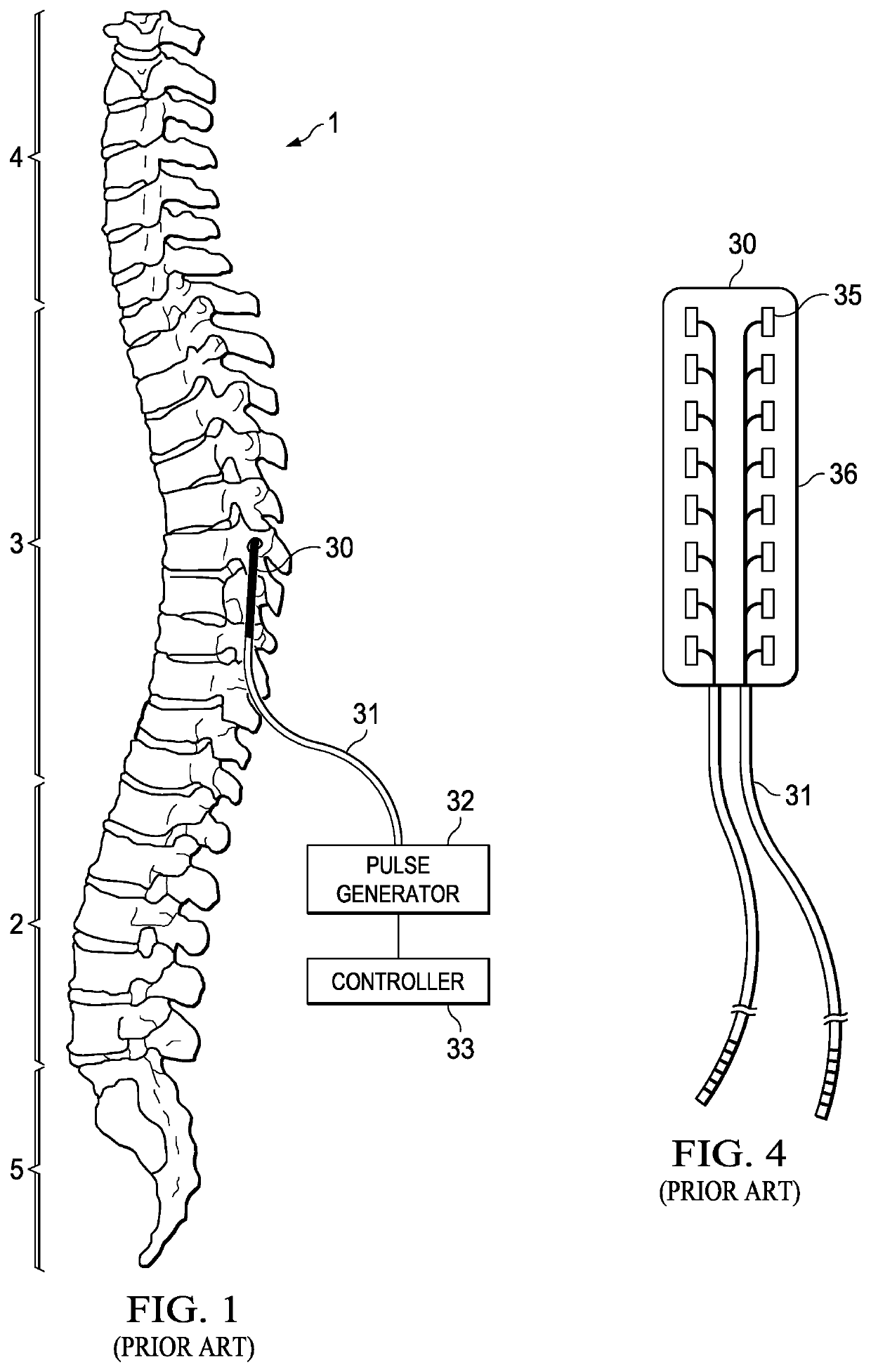 Randomized intermittent stimulation paradigm and method of use