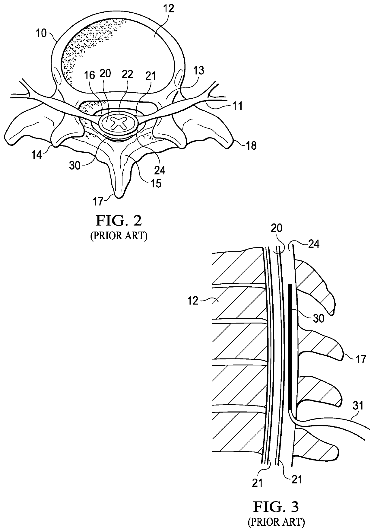 Randomized intermittent stimulation paradigm and method of use