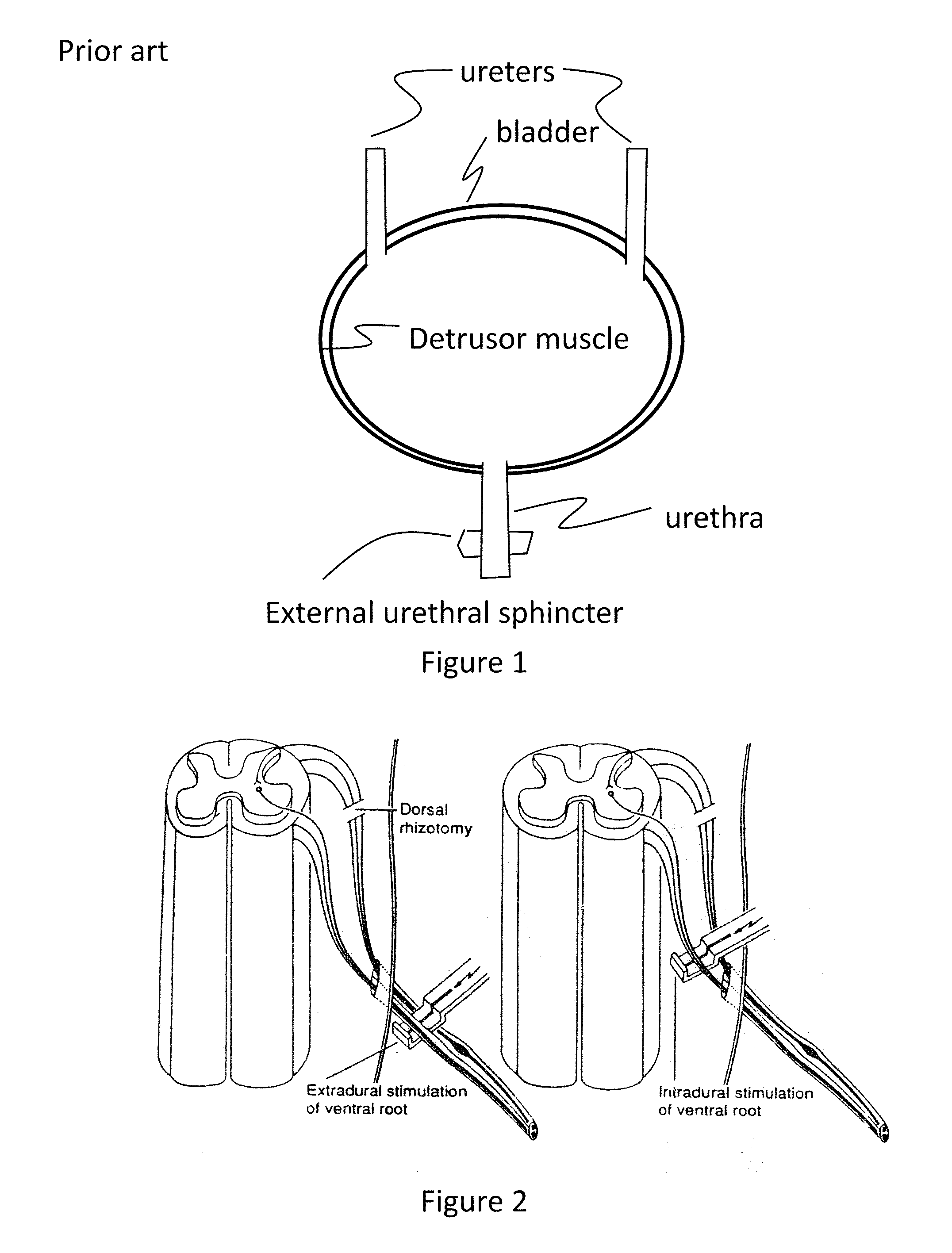 Sacral neurostimulation to induce micturition in paraplegics