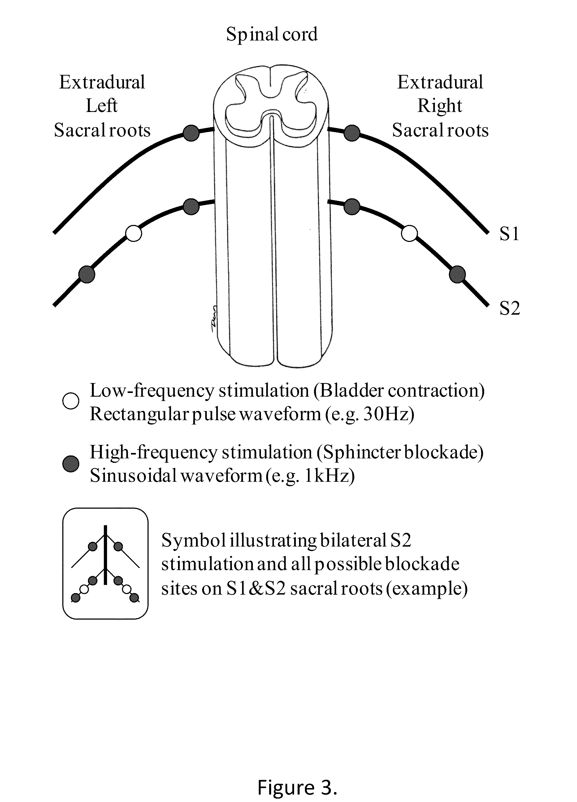 Sacral neurostimulation to induce micturition in paraplegics